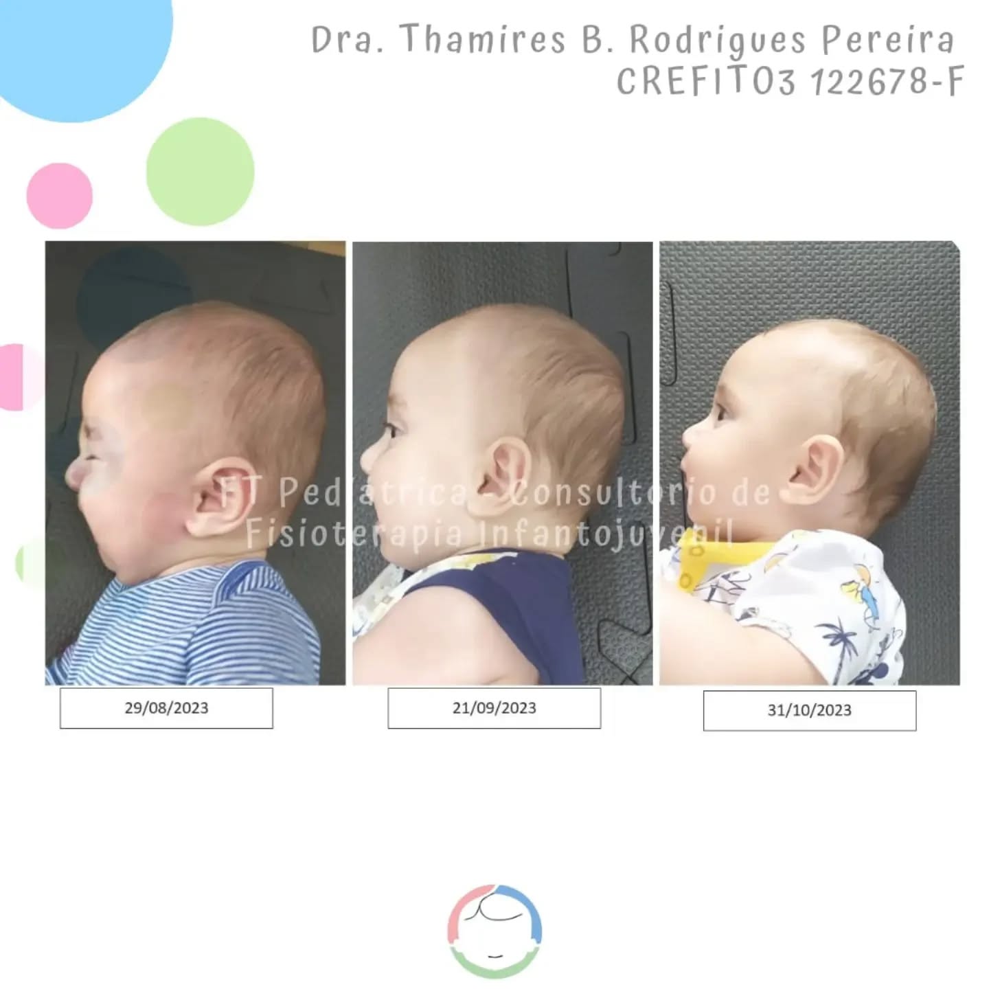 TBT desse caso lindo!
Bebê livre de torcicolo e assimetria.
Método De Setti
(Em formação)
@carolinadesetti
