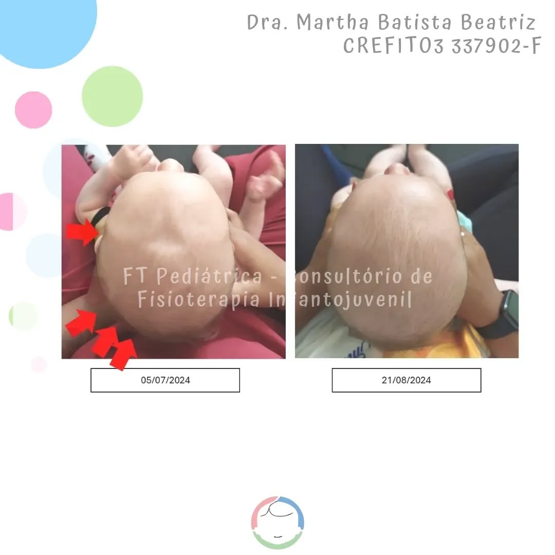Recuperar a integridade dos músculos e articulações trazendo mobilidade para o corpinho do bebê, resolvendo assim o Torcicolo Congênito, permitirá que o bebê se movimente livremente, possibilitando assim os estímulos às aquisições das etapas motoras (rolar, engatinhar...)
Com tecidos livres, há um crescimento harmônico dos ossos do crânio.
Isso é Método de Setti!
@carolinadesetti
Gratidão @dra.alinecravo pela confiança 🙏🏻❣️