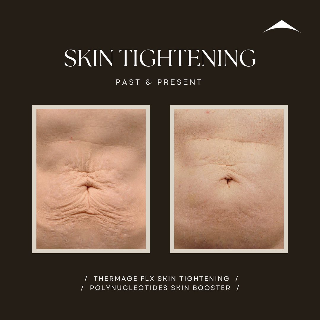 Thermage FLX is a non-invasive cosmetic procedure used for body tightening and contouring. It utilises most advanced monopolar radiofrequency (RF) energy to heat the deeper layers of the skin, stimulating collagen production and tightening loose or sagging skin. The procedure is particularly effective for areas such as the abdomen, thighs, arms, and buttocks, where skin laxity is a concern.
Thermage FLX can improve skin texture, reduce the appearance of cellulite, and provide a smoother, more youthful contour to the body. It is a popular choice for individuals seeking a non-surgical alternative to address skin laxity and achieve a firmer appearance. It is a single treatment with almost zero downtime producing results that last about 2 years.
#ThermageFLX #SkinTightening #BodyContouring #RadiofrequencySkinTightening #CollagenInductionTherapy #SkinLaxity #cellulitereduction #FirmerSkin #BodyTreatment