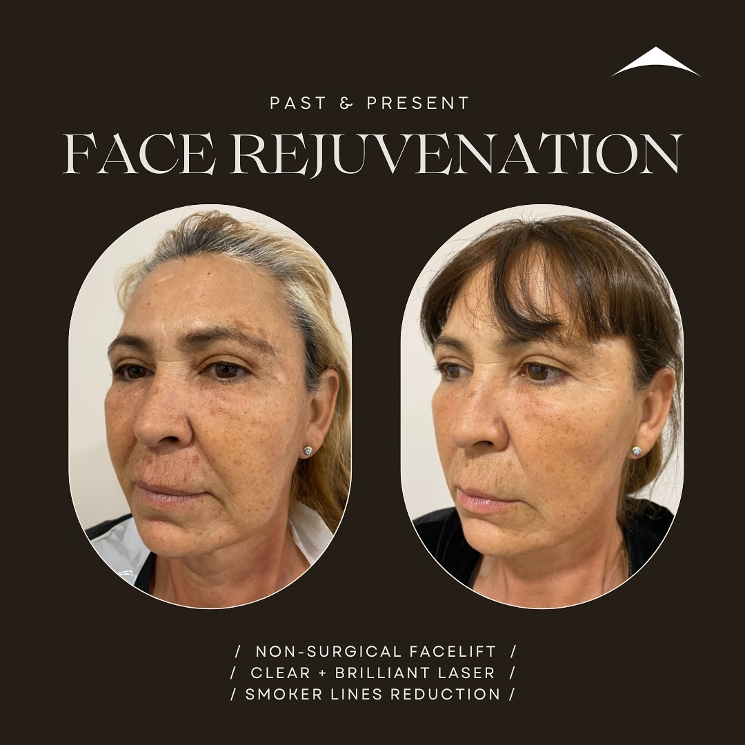 // Full Face Rejuvenation \\
Treatments:
1️⃣ PDO Threads Lift
2️⃣Clear + Brilliant Laser
3️⃣ Dermal Fillers
4️⃣ Botox
Results:
✔️ Facelift
✔️ Radiance
✔️ Smoker lines reduction
✔️ Cheek enhancement
🌍 www.montecosmet.com
#beforeandafter #fullfacerejuvenation #nonsurgicalfacelift #clearandbrilliantlaser #montecosmet