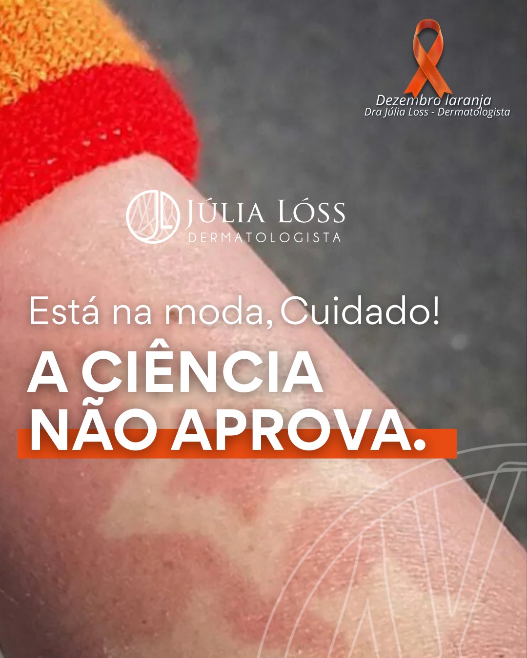 Nem tudo que viraliza é inofensivo.
Tendências como as chamadas sunburn tattoos exigem queimaduras solares para criar desenhos temporários na pele. Cada queimadura representa uma agressão profunda, acumulativa e associada ao aumento do risco de câncer de pele.
A pele não esquece esse tipo de dano.
Informação e prevenção continuam sendo as formas mais eficazes de cuidado, especialmente entre jovens.
Compartilhe esse alerta.
Dra. Júlia Lóss - Dermatologia Oncológica
CRM 5201085638 RQE 34041
#cancerdepele #queimadurasolar #prevencaosolar #dermatologiaoncologica #saudedapele #fotoprotecao #alerta