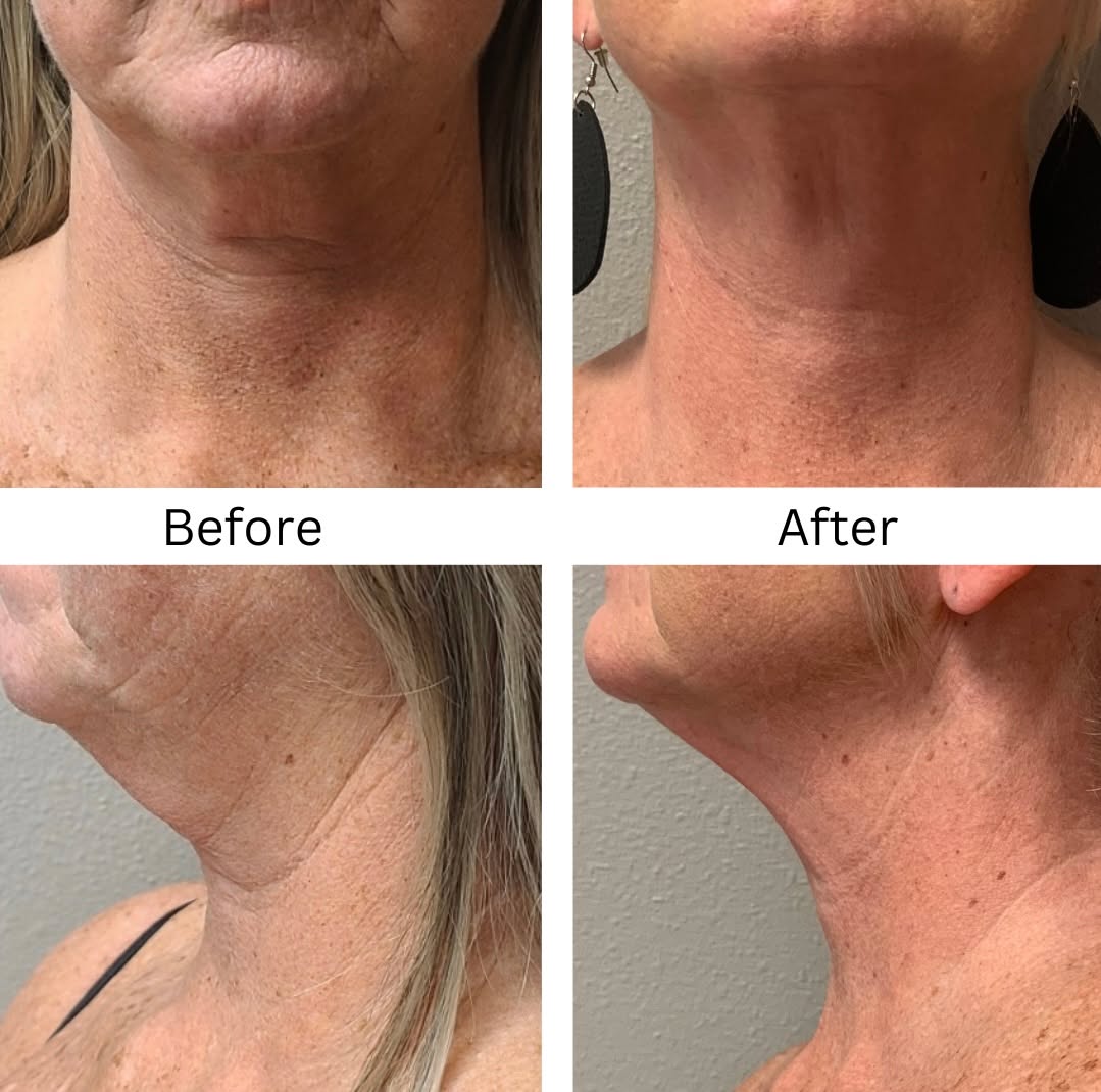 Exilis Neck Transformation
Before → After 4 sessions
Exilis uses radiofrequency + ultrasound to boost collagen & tighten the skin— no downtime required!
🚨 Why multiple sessions matter:
Collagen doesn’t rebuild overnight. Each sessions builds on the last, allowing your skin to gradually firm, tighten, and improve texture for long-lasting, natural results.
Perfect for crepey skin, laxity, and fine lines in the neck area!
❗️ Call or text to schedule your Exilis consultation!
📲 Call us : 319-939-1824
📍 Find us at : 212 E 4th St, Waterloo, IA 50703
🔗 https://dashboard.boulevard.io/booking/businesses/e42807b0-3d4c-4aba-9313-3910c14faa57/widget#/cart/menu to schedule your appointment today
💻 rejuvenatemedspaia.org
📱RepeatMD: https://rejuvenate.repeatmd.app/signin
#RejuvenateMedSpa