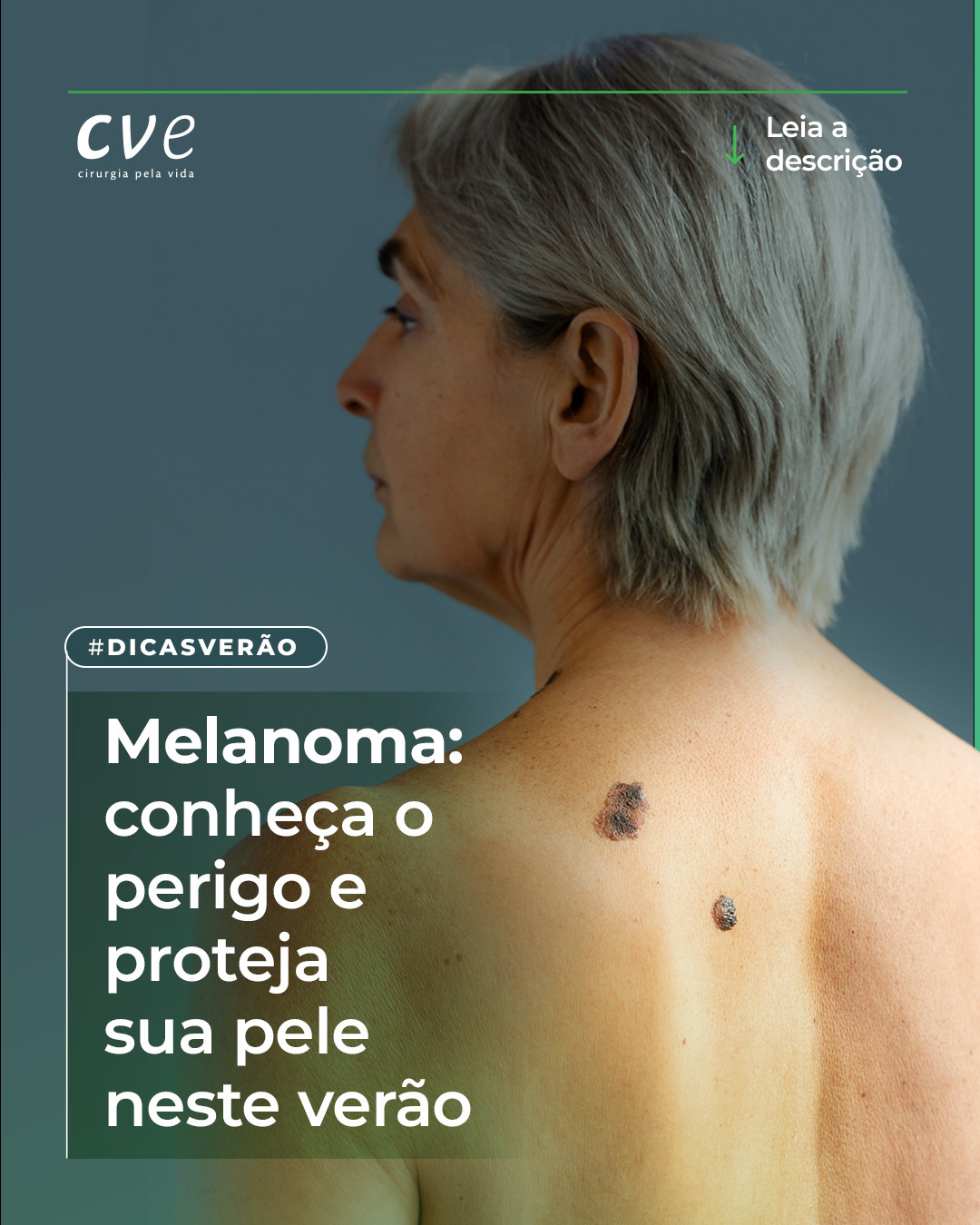 O melanoma é o tipo mais grave de câncer de pele, mas, com o diagnóstico precoce, as chances de cura aumentam significativamente. Fique atento aos sinais que podem indicar o desenvolvimento dessa doença e saiba o que fazer para se proteger.
1⃣ Mudanças nos sinais de pele: Fique atento a sinais que mudam de cor, tamanho e forma, principalmente se houver bordas irregulares.
2⃣ Novas manchas ou lesões: Se surgir uma mancha nova ou um sinal diferente, marque uma consulta com o dermatologista.
3⃣ Sinais de coceira, sangramento ou dor: Sintomas como coceira, sangramento ou dor em uma lesão podem ser sinais de alerta.
Durante o verão, quando a exposição ao sol é maior, a proteção da pele é essencial. Use sempre protetor solar, evite a exposição nos horários de pico e prefira roupas e chapéus que protejam a pele.
O melanoma pode ser tratado com mais eficácia se detectado logo no início. Não deixe de cuidar da sua saúde e, caso perceba qualquer sinal diferente, consulte um dermatologista. Cuide-se!