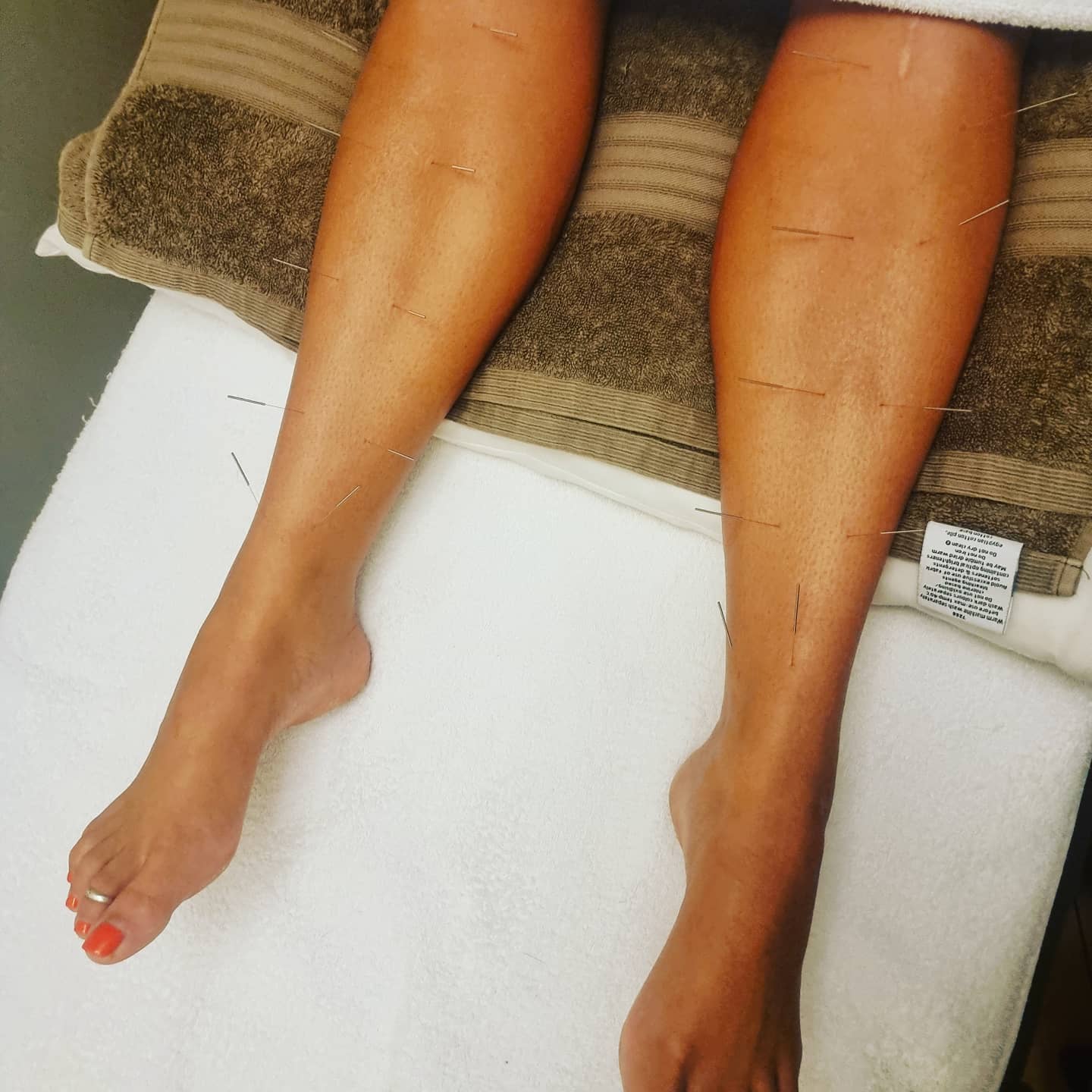 #acupuncture #acupuncturelife #acupuncturedoctor #ancientmedicine #modernunderstanding #modernacupuncture #acupunctureworks #acupuncturerocks #acupuncturist #acupuncturebrisbane #neckpain #shoulderpain #headache #headacherelief #traps #electroacupunture #electroacupuntura