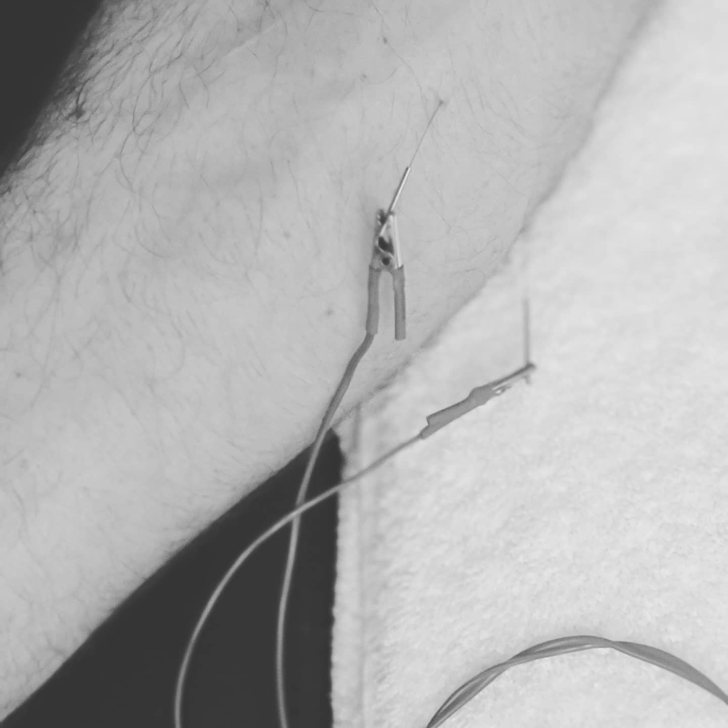 #acupuncturelife #acupunctureneedles #electroacupunture #acutepain #chronicpain #acupuncture #acupuncturedoctor #acupuncturist #elbowpain #elbowpainrelief #acupunctureworks #acupuncturerocks #acupuncturebrisbane #acupuntura #golferselbow #golferselbowtreatment #medialepicondylitis