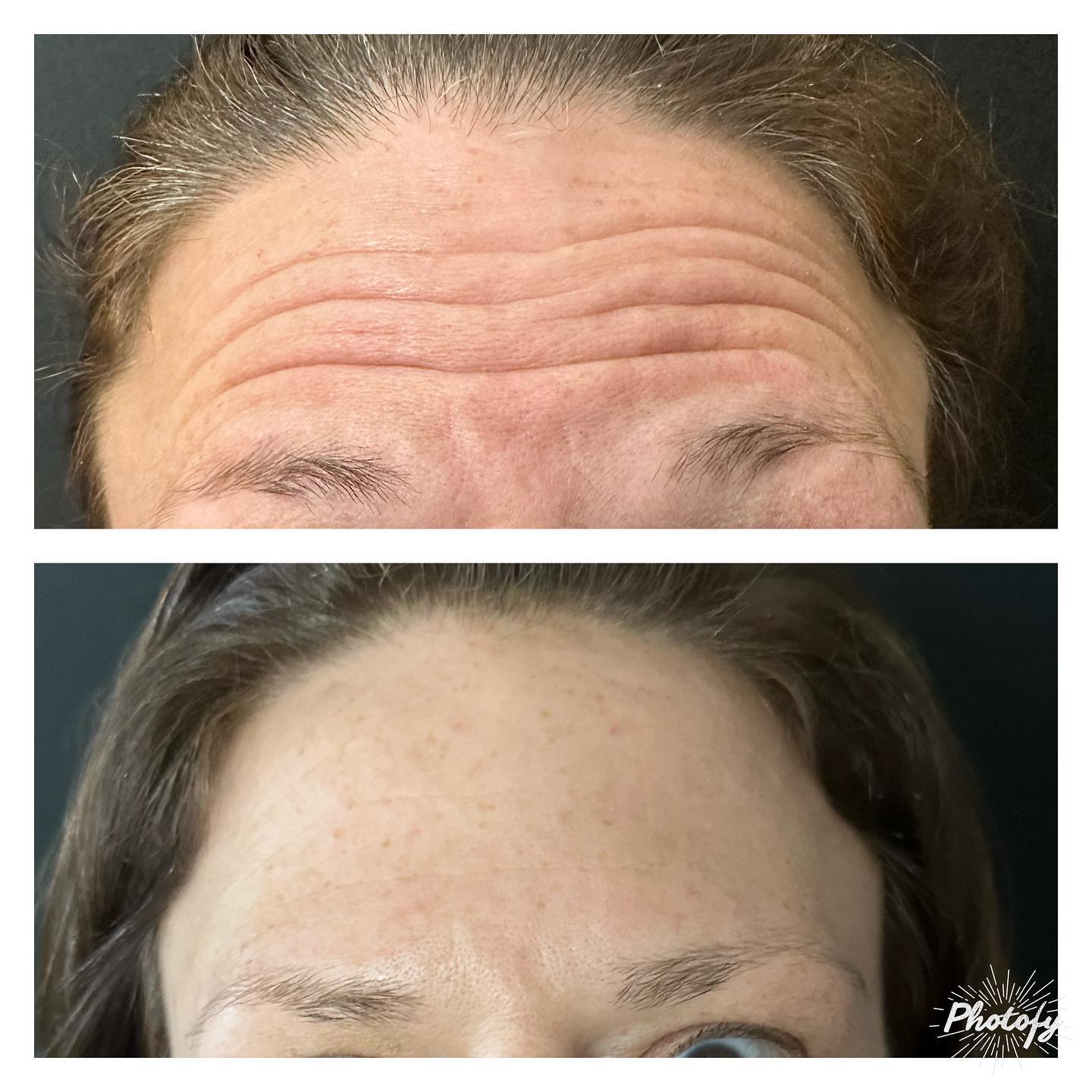 Check out these amazing results! DM to book an appointment or schedule a Botox party! #mobilebotox #botoxparty #npinjector #smallbusiness #xeomin #jeveau #botoxcolumbusohio