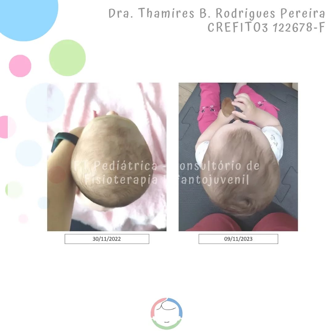 Vamos de TBT hoje! Acho que eu já tinha postado a evolução no tratamento dessa bebê. Está aí o resultado final no dia da alta! Mais uma bebê livre de torcicolo e Assimetria, pronta para explorar o mundo! ❤️
Gratidão @carolinadesetti por sua generosidade em multiplicar conhecimento.
Método De Setti, em formação (leia - muito estudo), desde 08/21.