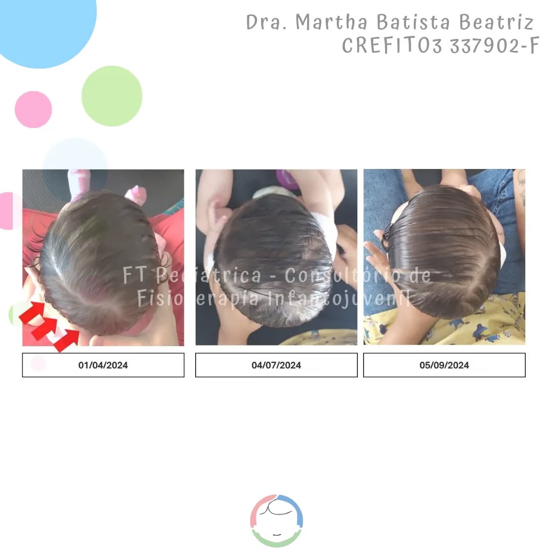 O tratamento é longo sim! Pois o formato do crânio é só a "ponta do iceberg". É necessário tratar todas as tensões e compensações que estão no corpinho do bebê! É sobre tratar a causa!! Além disso, acompanhamos o desenvolvimento motor do bebê... Garantindo um bebê livre de travas, que se movimenta, explora, cresce e se desenvolve de forma saudável.
Método De Setti (em formação)
@carolinadesetti