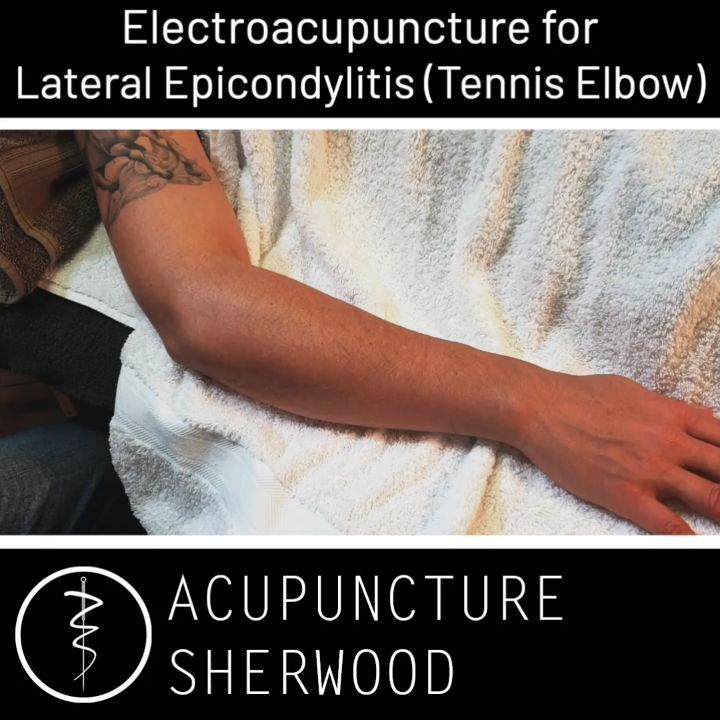 #acupuncturelife #acupunctureneedles #electroacupunture #acutepain #chronicpain #acupuncture #acupuncturedoctor #acupuncturist #elbowpain #elbowpainrelief #acupunctureworks #acupuncturerocks #acupuncturebrisbane #acupuntura #tenniselbow #tenniselbowtreatment #lateralepicondylitis