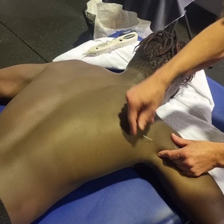 Needling and stimulating the posterior deltoid. Thanks again to @shapeupboxingandfitness for having me.
#acupuncture #acupuncturelife #acupuncturedoctor #ancientmedicine #modernunderstanding #modernacupuncture #acupunctureworks #acupuncturerocks #acupuncturist #acupuncturebrisbane #neckpain #shoulderpain #headache #headacherelief #traps #electroacupunture #electroacupuntura