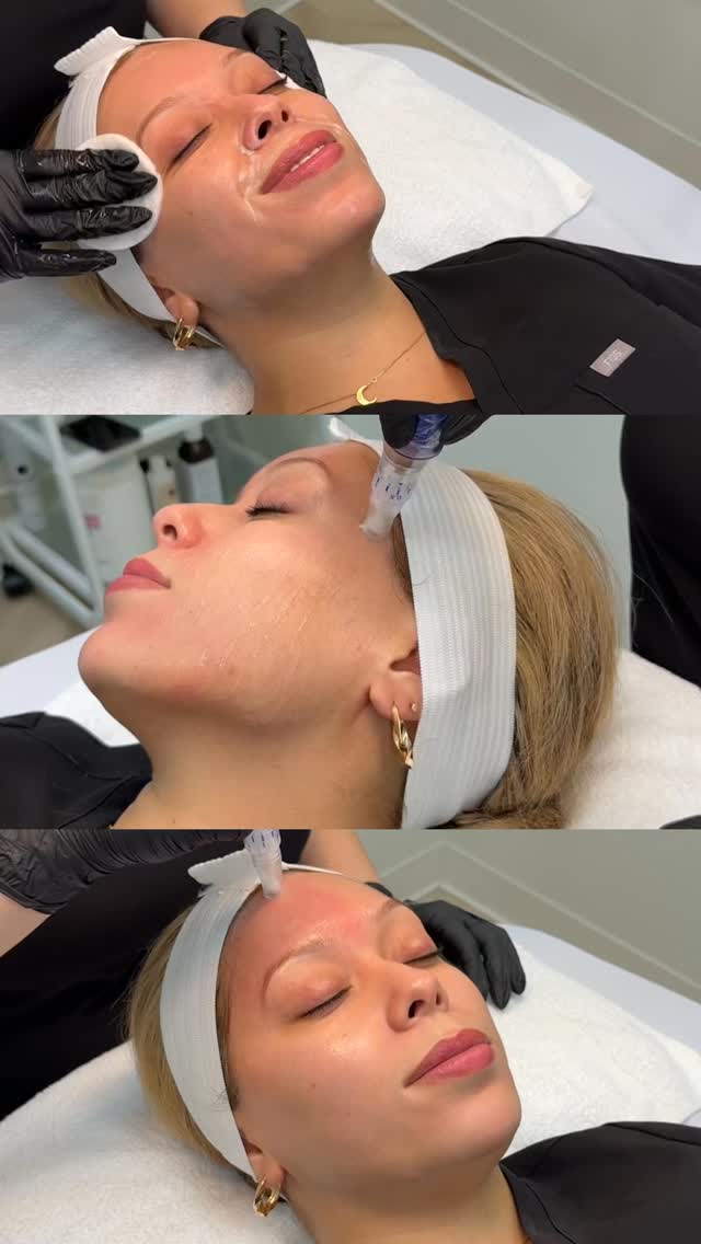 Tiny needles, timeless glow â¨
Microneedling gently boosts collagen to smooth, brighten, and refresh your skin from the inside out because radiant skin never goes out of style đ
#wheaton #naperville #glenellyn #glowup #libreaesthetics #medspa #microneedling #skinpen
