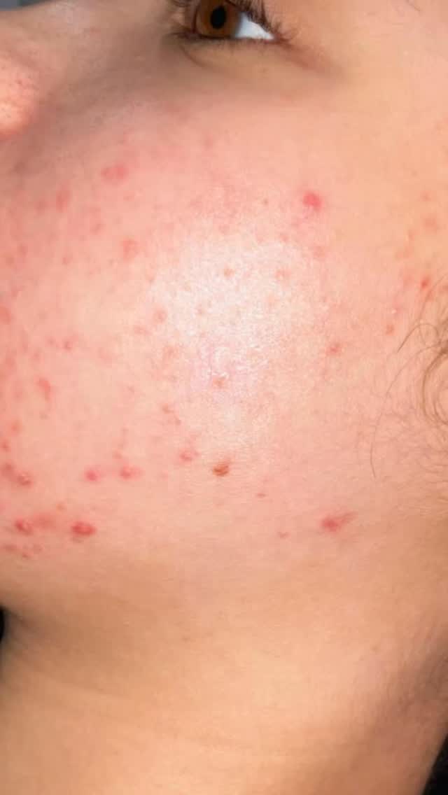 Switching to Pretty Faces Atlanta’s skincare routine can truly transform your skin 🫧 From stressed and irritated to clear and healthy. For a limited time, enjoy 15% off all PFA products. Gift cards are also available for loved ones who deserve great skin this holiday season. #skincaresale #skincareatl #clearskin #acne #hyperpigmentation