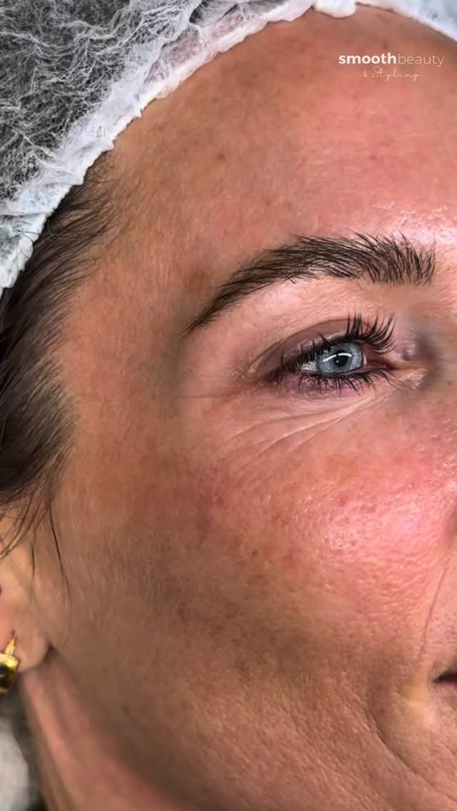 Smile lines and crow’s feet don’t automatically mean injectables or surgery.
Fibroblast Plasma Pen is a non-surgical, non-injectable, NO-SCALPEL skin tightening treatment designed to stimulate your skin’s own repair system.
Using German Designed controlled plasma energy, the treatment creates precise micro-thermal points on the skin’s surface, triggering immediate tissue contraction and activating fibroblast cells—the cells responsible for collagen, elastin and skin firmness.
✨ As collagen is stimulated in the lower layers, the skin softly plumps and strengthens from within—improving firmness without adding artificial volume… so ultimately you stay looking like yourself, just winding back the 🕰️
Why clients choose fibroblast:
• No needles
• No scalpel
• No “overfilled” look
• Tightens loose or crepey skin
• Softens fine lines and wrinkles
• Improves skin texture and firmness over time
• Results continue to improve as collagen remodels
This is skin regeneration, not camouflage.
Your skin—just firmer, smoother and more refined.
📍Bondi
📩 DM PLASMA to book a consultation
🔗 Limited appointments available