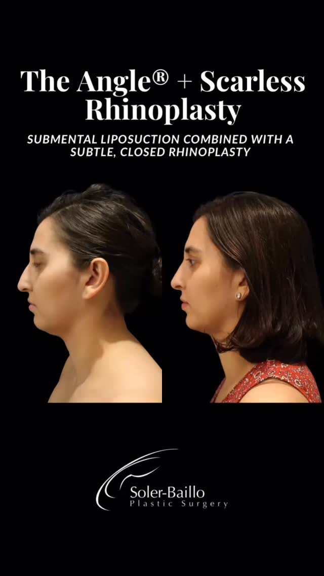 📐Small changes. Powerful balance.
Closed rhinoplasty with osteotomy and Dr. Soler-Baillo’s signature The Angle® procedure = precision designed to enhance, never overpower.
By subtly refining nasal structure and sculpting the chin–neck junction, we create harmony across the entire profile, not a ‘done’ look.
🗓️ Book your consultation to learn more!
☎️ 305-661-1996
🌴 Coral Gables, Florida
#drsolerbaillo #chinliposuctionbeforeandafter #chinlipo #subtlerhinoplasty #neckliposuction