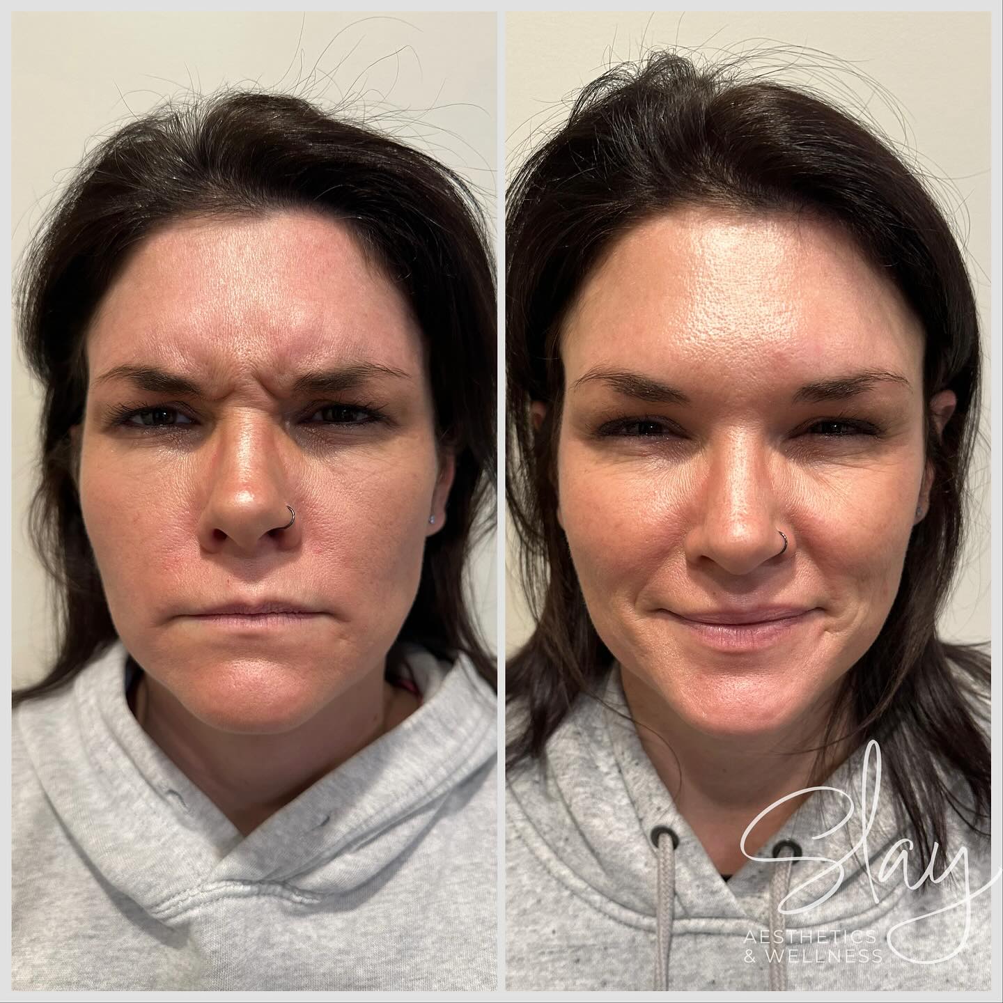 Wrinkles checked out, confidence checked in! 🔥 #BotoxGlowUp#botoxnewark#xeomin #botox #medspanewarkoh