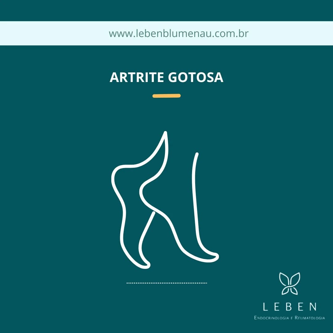 A artrite gotosa é uma condição que causa dor intensa e inchaço nas articulações, geralmente no primeiro dedo do pé, conhecida como podagra. Os sintomas surgem repentinamente, muitas vezes à noite, com dor aguda, inchaço, vermelhidão e calor na área afetada. As crises podem ser desencadeadas por fatores como excesso de álcool, alimentos ricos em purinas e certos medicamentos.
Para aliviar as crises agudas, são usados medicamentos como anti-inflamatórios não esteroides (AINEs), colchicina e corticosteroides. O alopurinol é utilizado para reduzir a produção de ácido úrico e prevenir futuras crises.
Uma dieta equilibrada é crucial para controlar a gota. É recomendado consumir alimentos com baixas quantidades de purinas, como vegetais frescos (espinafre, cenoura), frutas cítricas e cereais integrais. Alimentos a serem evitados incluem carnes vermelhas, frutos do mar e bebidas alcoólicas.
**Dicas Práticas:**
- **Coma** vegetais frescos e frutas cítricas.
- **Evite** carnes vermelhas e frutos do mar.
- **Beba** bastante água para ajudar na eliminação do ácido úrico.
Com essas estratégias, é possível gerenciar os sintomas e prevenir crises futuras, melhorando significativamente a qualidade de vida dos pacientes com gota.
------------------------------------------
Clínica Leben
WhatsApp (47) 99951-1836
Blumenau- Santa Catarina
-----------------------------------------
#gota #artrite #gotosa #reumato #reumatologista #dor #inflamação #doença #pes #maos #acidourico #leben #prevencao #promoção #saude #clinica