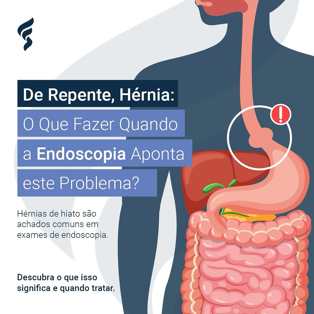 De Repente, Hérnia: O Que Fazer Quando a Endoscopia Aponta o Problema ?
Você fez uma endoscopia e se deparou com o termo “hérnia de hiato” no laudo? Calma, essa é uma condição comum — e nem sempre significa algo grave. ❗
A hérnia de hiato ocorre quando uma parte do estômago ultrapassa o diafragma e se projeta para o tórax. Ela pode estar associada a sintomas como azia, refluxo, dor no peito e sensação de estômago cheio após pequenas refeições. ?
Embora muitos casos não necessitem de intervenção, é importante entender quando o tratamento é necessário — seja com mudanças alimentares, uso de medicações específicas ou, em situações mais complexas, cirurgia. ?
No consultório, avaliamos cada caso com atenção, considerando exames, sintomas e estilo de vida do paciente. ?⚕️
O diagnóstico claro é o primeiro passo para um cuidado seguro e eficaz. ✅
#DrFernandoSavóia #HérniaDeHiato #Endoscopia #SaúdeDigestiva #RefluxoGastroesofágico #Prevenção #DiagnósticoPreciso #BemEstar