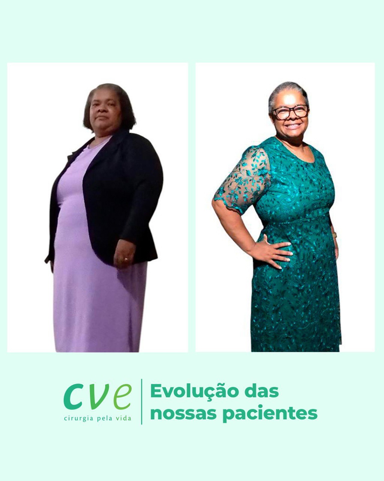 4 meses depois do procedimento, a transformação já é visível — e sentida em cada detalhe da rotina.
“Sou grata a Deus por me dar coragem e ao Dr. Marcus Martins e toda a equipe da CVE por me acompanharem com tanto cuidado.” ?
Parabéns, Kátia Quirino! Que sua jornada continue leve, saudável e cheia de conquistas.