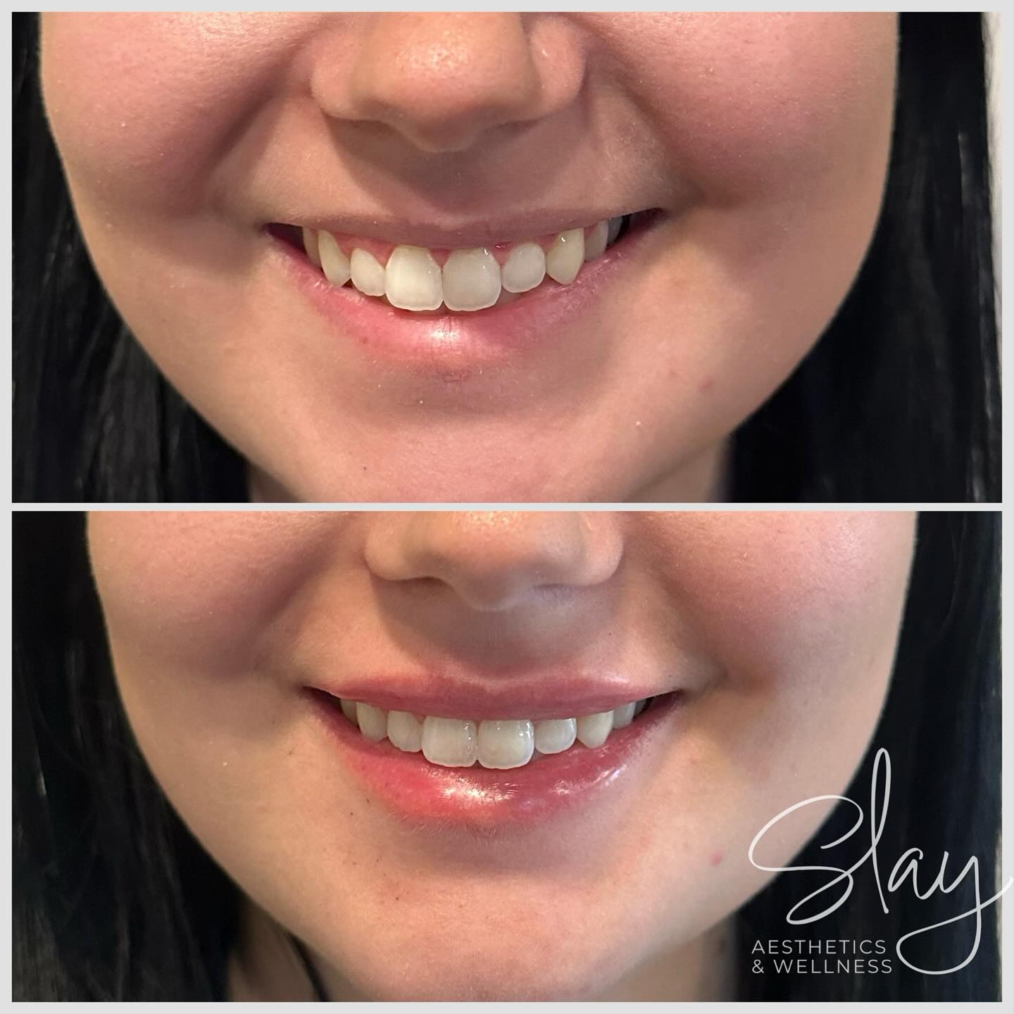 ☀️💋 Who needs NEW LIPS for the summer?!
Pool days. Vacay pics. Patio mimosas.
✨ Your lips deserve a glow-up too!
Let’s get you perfectly plumped and selfie-ready 📸
🗓 DM to book!
#RHA #LiveFiller #NewarkAlert #FillerNewark #BotoxNewark #XeominNewark