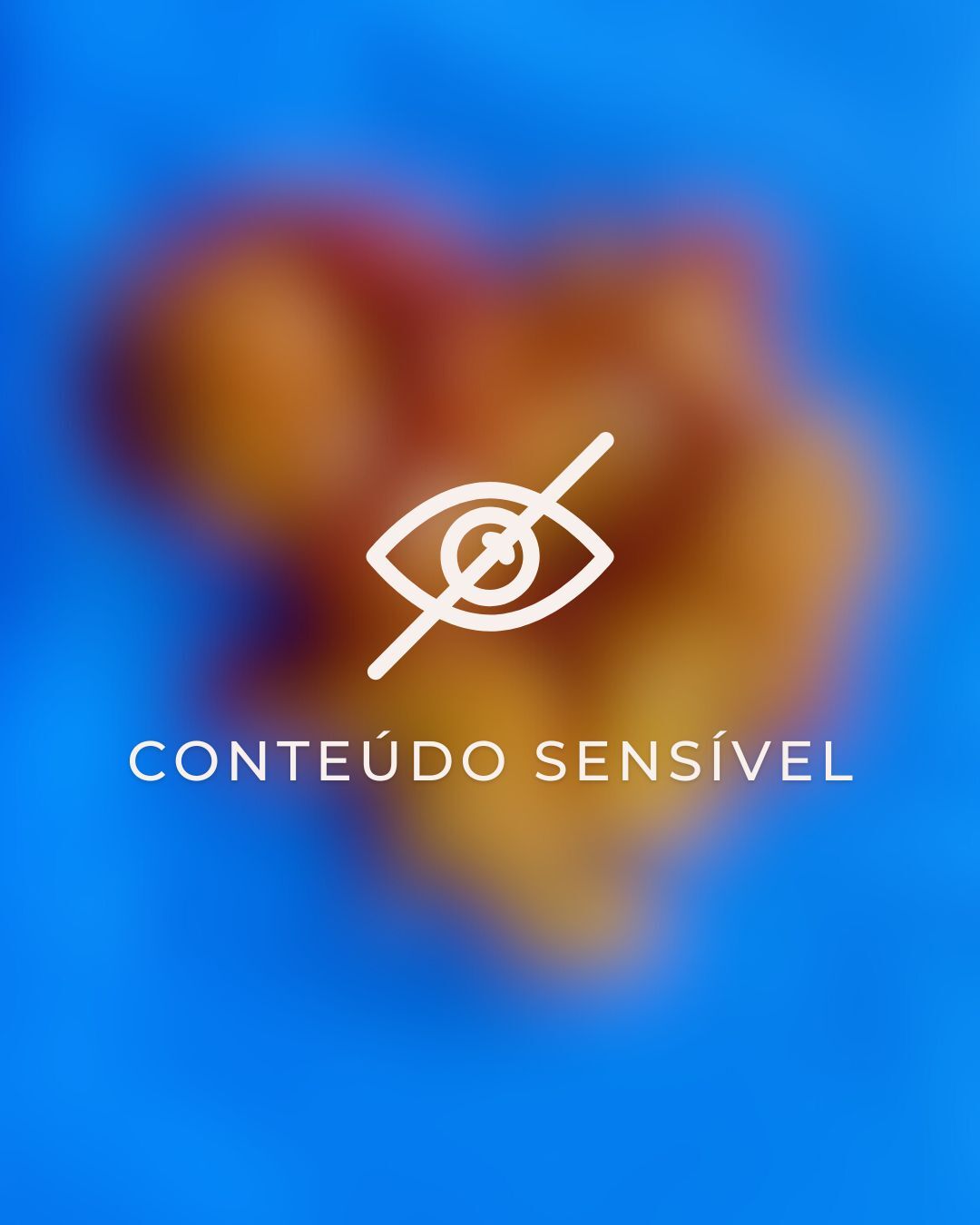 Realizamos a cirurgia para remoção de um tumor de partes moles localizado na região escapular direita do paciente.
Durante o procedimento, pela avaliação macroscópica, foram identificadas características sugestivas de um lipoma, uma tumoração benigna composta por tecido adiposo.
No entanto, é fundamental aguardar o resultado do exame histopatológico (biópsia) para confirmar o diagnóstico definitivo. Isso porque, embora a maioria desses tumores sejam benignos , sempre consideramos o sarcoma como um importante diagnóstico diferencial.
Vale lembrar que o sarcoma é um tumor maligno que exige abordagem e acompanhamento específicos! ⚠️
Deve-se estar atento a todos os detalhes para garantir o melhor cuidado e tratamento para o paciente. Agora, aguardamos os exames complementares e seguiremos com o acompanhamento necessário.
Comente aqui: Você já conhecia esse procedimento? 👇🏻
#drjosepantaleao #cirurgiabariatrica #bariatrica #cirurgiaaparelhodigestivo #aparelhodigestivo #qualidadedevida #tumordepartesmoles #biópsia