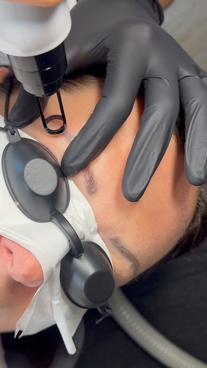 ✨ Envie de corriger ou retirer un maquillage permanent ?
Le détatouage est LA solution ! 🔄
Que ce soit pour estomper une ancienne pigmentation, corriger une forme ou simplement retrouver une peau plus neutre, plusieurs techniques douces et efficaces existent 💫
⏳ Résultat progressif
🧖♀️ Sur-mesure selon votre peau et vos besoins
📍Prenez rendez-vous pour un diagnostic personnalisé et repartez sur de bonnes bases !