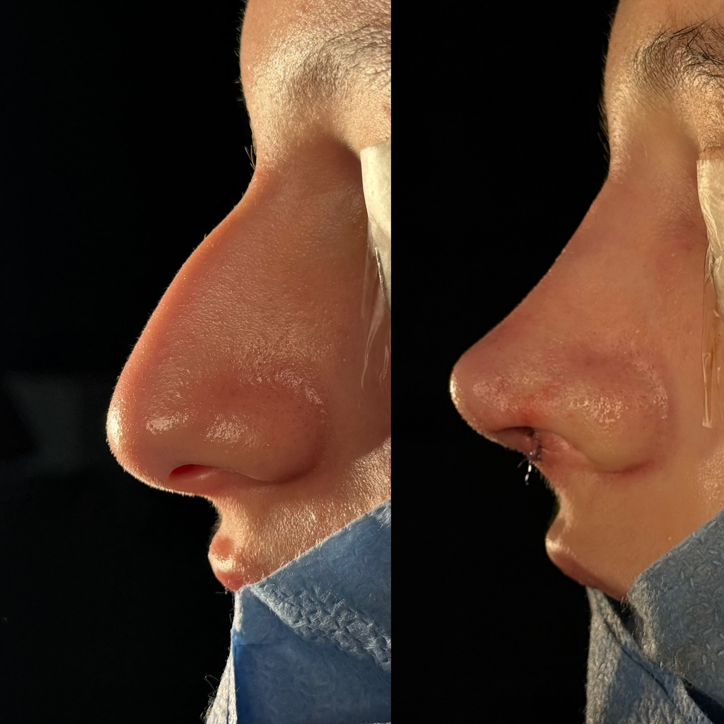 Rinoplastia primária ultrassônica ???
mais importante do que idealizar um nariz perfeito, é compreender o que é possível dentro da sua anatomia, da técnica cirúrgica e da harmonia do seu rosto. Um bom resultado não nasce da fantasia, mas do alinhamento claro entre o que você espera e o que a cirurgia pode realmente oferecer.
“A expectativa é a raiz de todo o coração partido.”
— William Shakespeare (juro, a frase é dele mesmo ???).