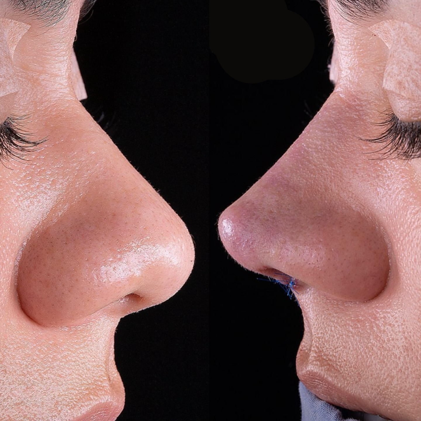 Nao@complique sua rinoplastia. Curta assim, discreta e delicada. Como deve ser ?