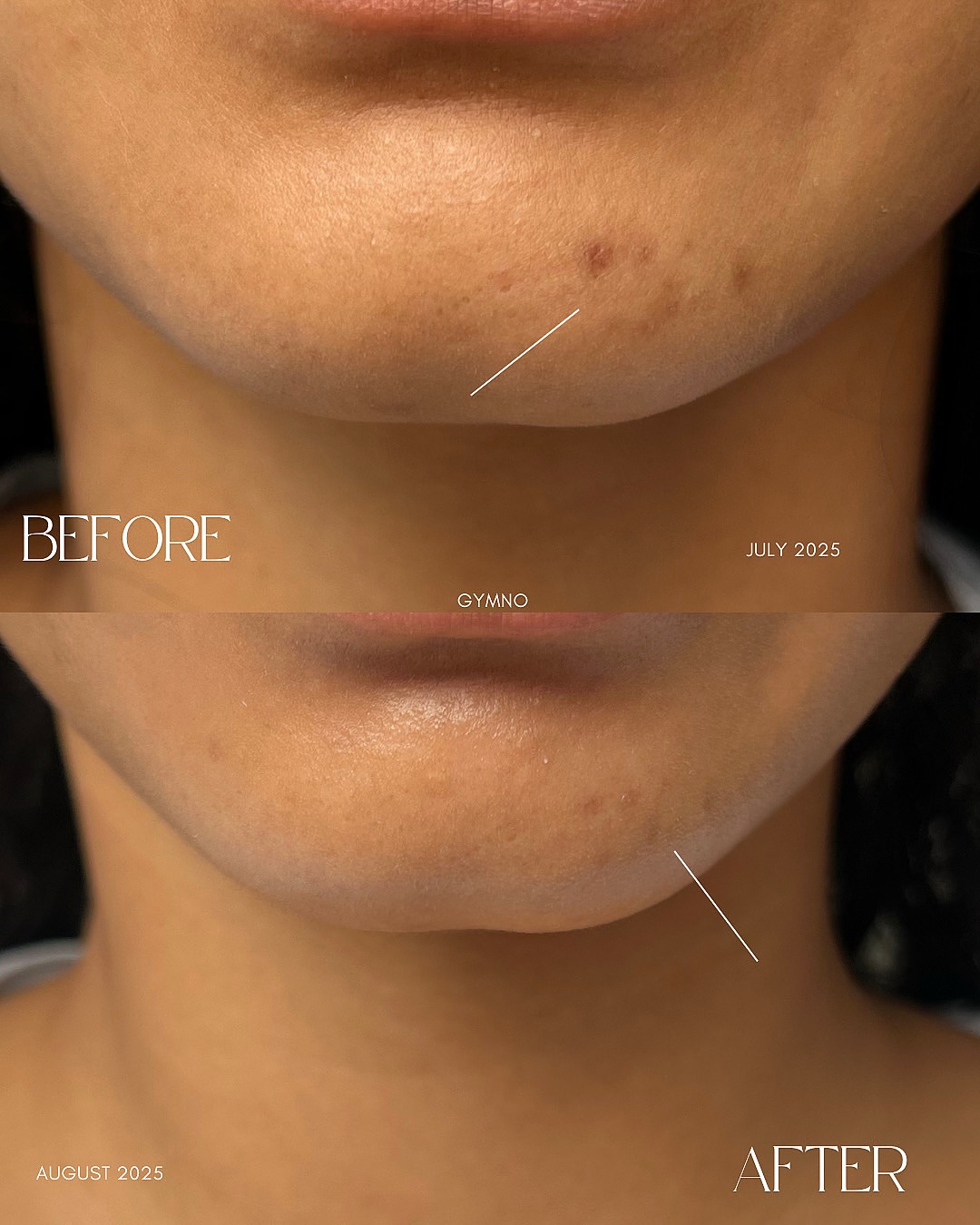 Hyperpigmentation before and after 1 month progress.
In clinic:
1 Cellstory liquid microneedling
1 Deluxe facial
#hyperpigmentation #skincare #beforeandafter #nyc #cellstory #beyondmiracles #nycfacials