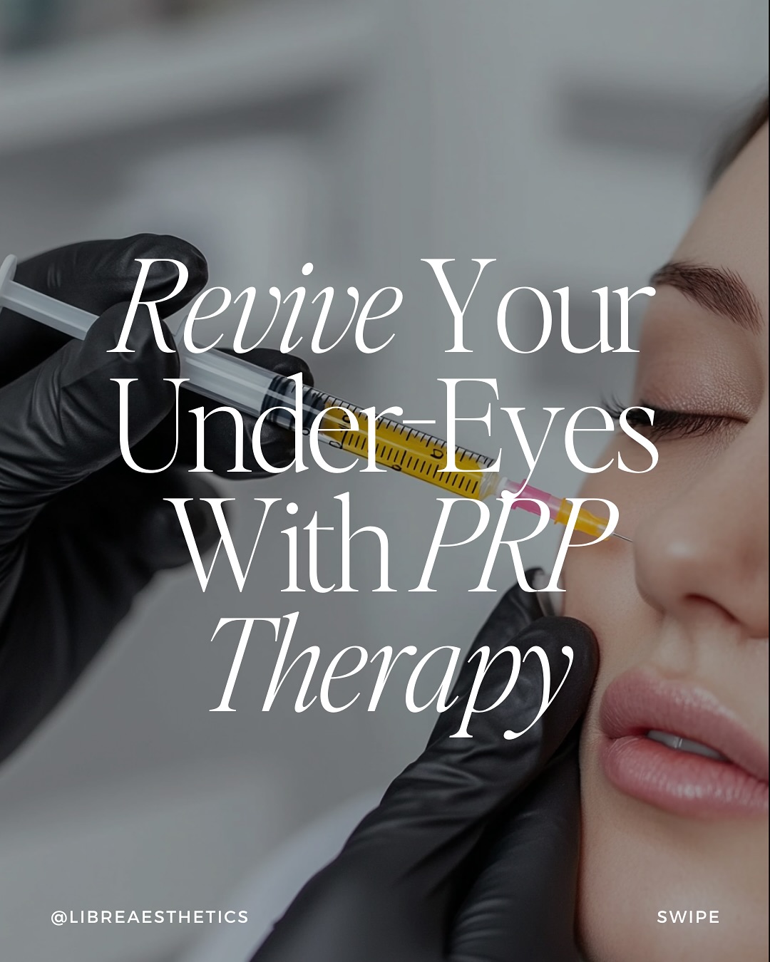 Looking a little tired? Letâs turn that around! đâ¨
PRP therapy is like a reset for your under-eyes and helps by fading dark circles, smoothing fine lines, and reducing puffiness, all with your bodyâs natural healing power.
The results? Fresh, natural, and effortlessly glowing. Ready to try PRP? Letâs talk, schedule your next consultation at LibrĂŠ! â¤ď¸
#prptreatment #wheaton #naperville #oakbrook #glenellyn #facial