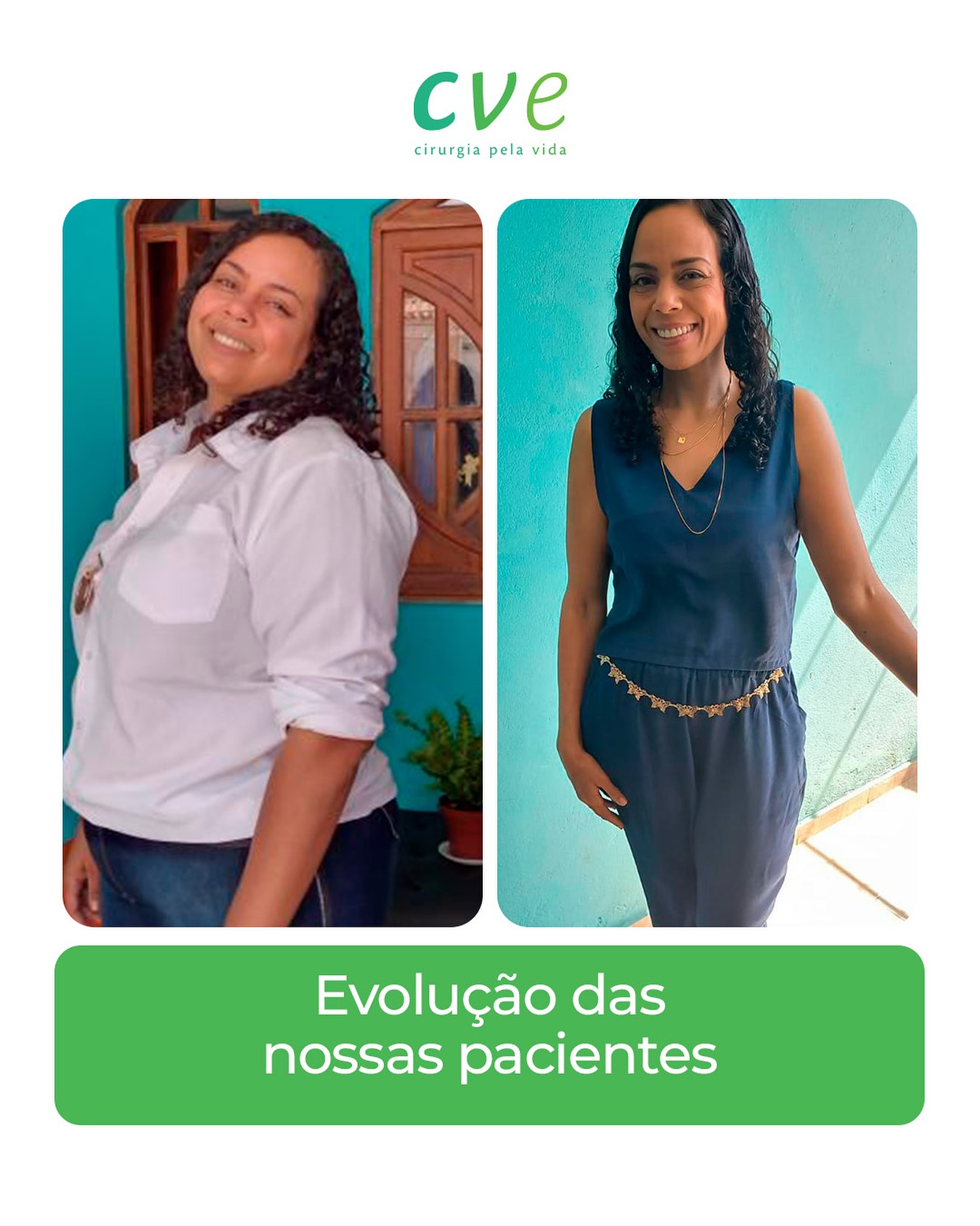 Hoje é dia de conhecer a história da paciente Amanda Pires. Conheça um pouco da sua trajetória:
“Fiz minha cirurgia em 2021 com o Dr. Marcus Martins.
Pesava 123 kg e, em apenas 1 ano, quase cheguei ao meu peso ideal. Venho mantendo entre 68 e 72 kg há 3 anos.
Com 1 semana, já havia perdido 10 kg e, com 1 mês, minha menstruação passou a ser regular.
Meu endométrio, que era muito pouco espesso por causa da obesidade e do ovário policístico, voltou ao tamanho normal — e pude engravidar.
Minha primeira gestação foi com 1 ano e 6 meses de cirurgia, e hoje minha segunda filha tem 5 meses.
Estou super satisfeita! ?