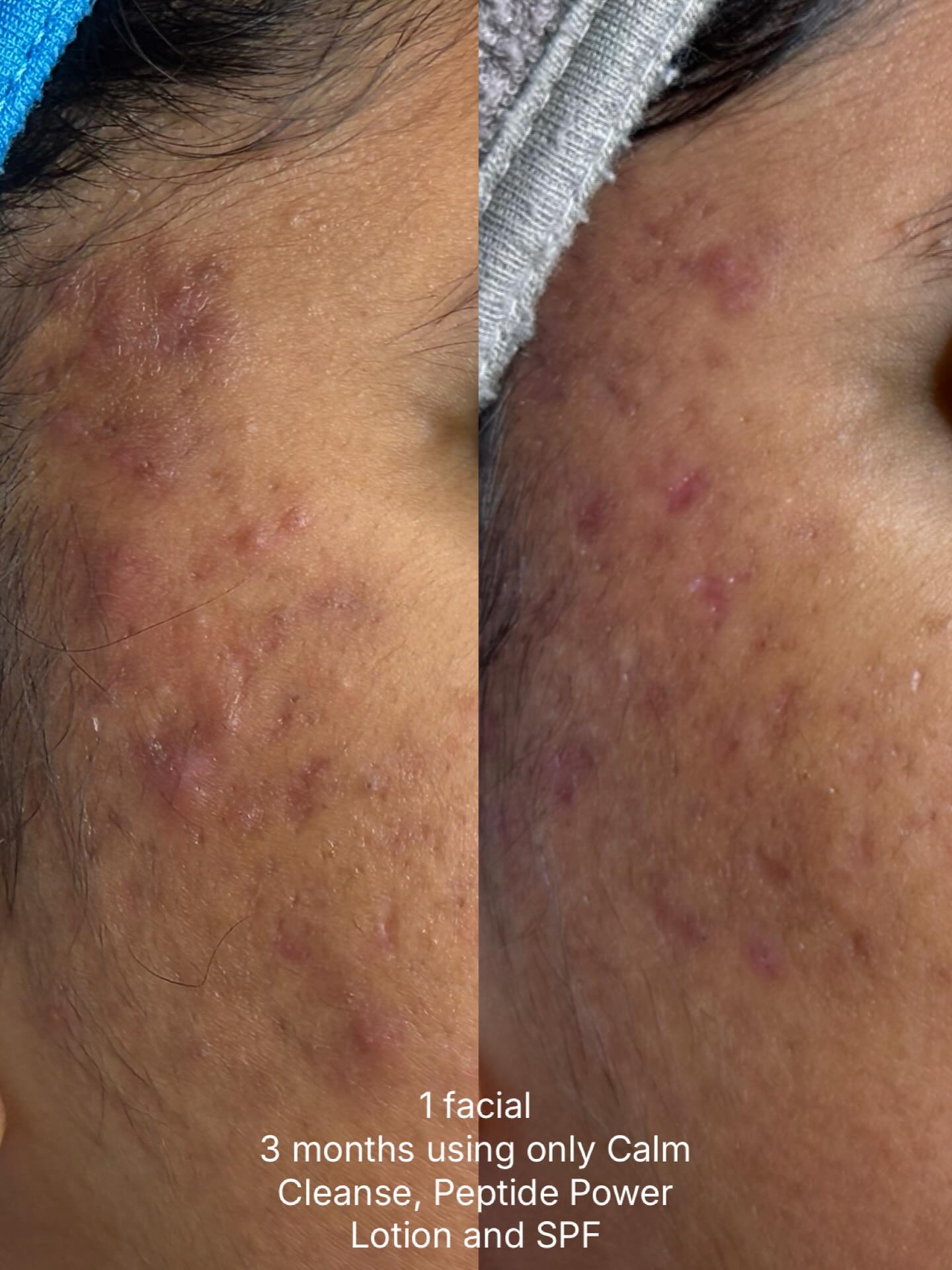 After 1 acne facial and using Calm Cleanse, Peptide Power Lotion and acne-safe SPF my clients inflamed acne has healed up!
The post inflammatory pigmentation is still there and we will continue working to clear her smaller breakouts and even the skin tone- but before her first facial and using proper skincare her acne was super inflamed and raised. 3 months later and the areas that were breaking out are now flat!🫶🏼🪩