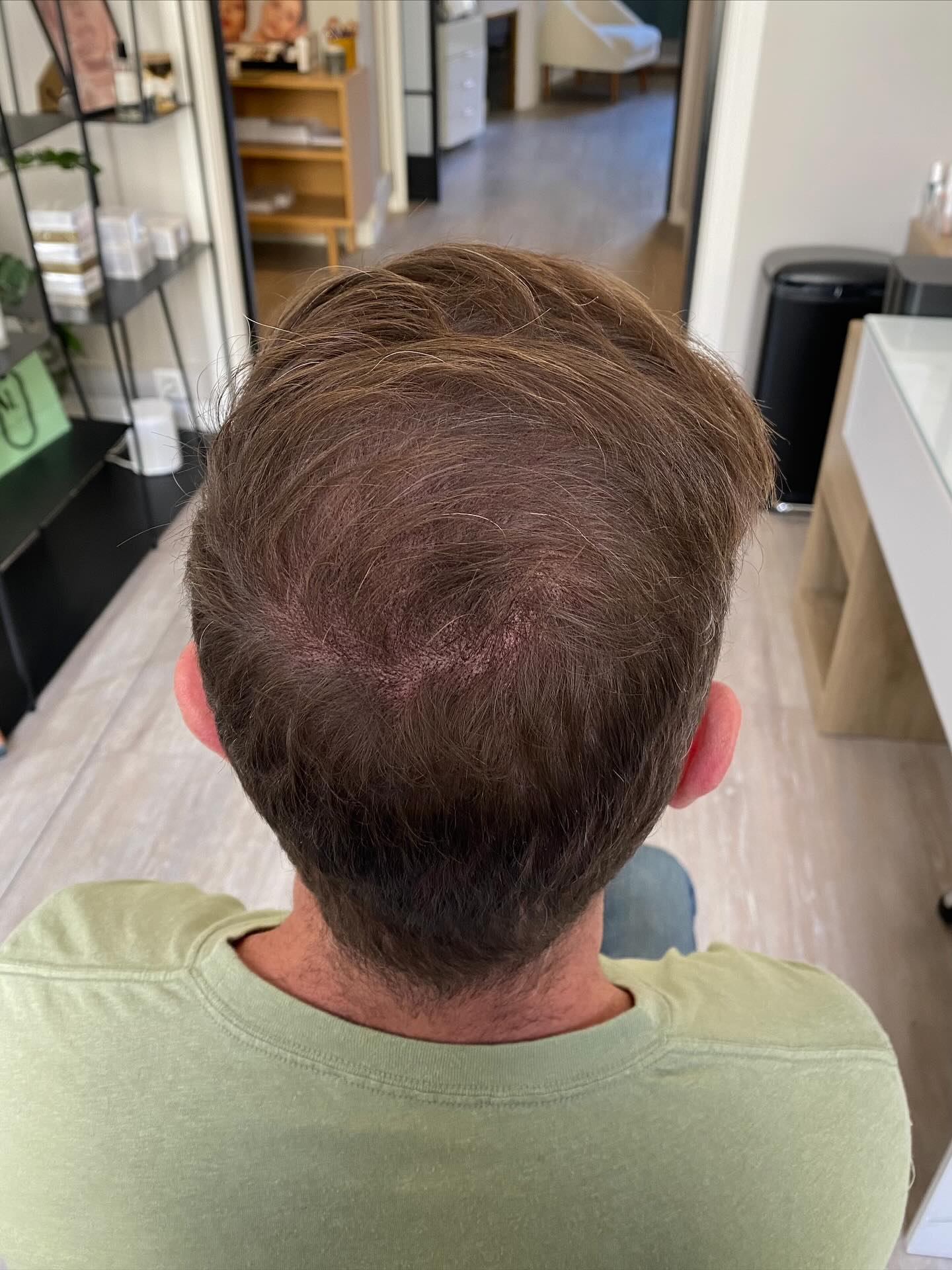 ✨ Résultat de tricopigmentation ✨
Ici, un travail pour redonner une impression de densité naturelle et camoufler les zones clairsemées.
Le résultat est immédiat, tout en restant discret et harmonieux 💫
La tricopigmentation est une solution non invasive qui permet de retrouver confiance en soi sans chirurgie.
👉 Adaptée aussi bien aux hommes qu’aux femmes
👉 Effet rasé ou effet densité selon le style souhaité
👉 Résultat naturel garanti 🌿
📩 Pour plus d’informations ou pour un diagnostic personnalisé, écris-moi en message privé !
#tricopigmentation #densitécapillaire #cheveux #solutionchutecheveux #nicebeaute #looknaturel #confianceensoi #estheticienne