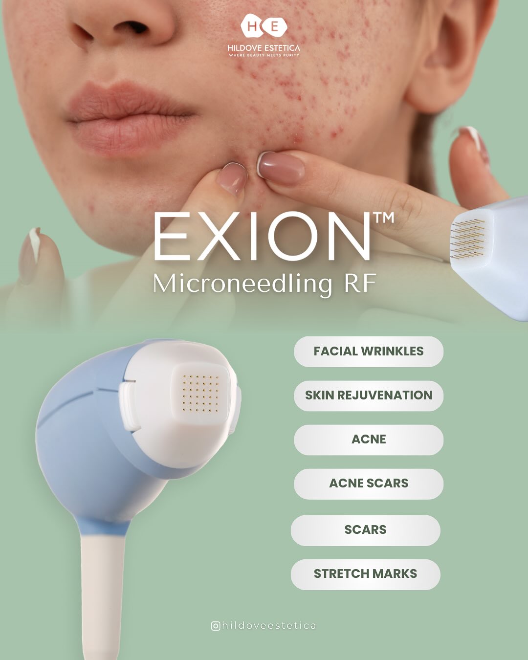 Transformasi Kulit Instan dengan Microneedling RF by EXION
Microneedling RF by EXION adalah inovasi terbaru dalam perawatan kulit yang memadukan teknologi microneedling dan frekuensi radio. Dengan stimulasi mendalam yang merangsang kolagen dan elastin, perawatan ini efektif mengurangi garis halus, pori-pori besar, dan bekas jerawat, sekaligus meningkatkan tekstur kulit secara keseluruhan.
Dapatkan kulit yang lebih kencang, halus, dan bercahaya dengan hasil yang terlihat alami. Perawatan ini aman, cepat, dan memberikan hasil optimal dengan downtime minimal. Rasakan transformasi kulit Anda di Klinik Gading Dermatology, di mana teknologi terkini bertemu dengan perawatan profesional terbaik.
โ
๐๐๐๐๐ข๐ฉ๐ ๐๐ฆ๐ง๐๐ง๐๐๐
Ruko Mahkota Raya Blok E No. 10, Kota Batam
WA: +62 811 776 889
Operational hours:
Monday - Sunday: 10.00 AM - 08.00 PM
Sunday: 10.00 AM - 05.00 PM