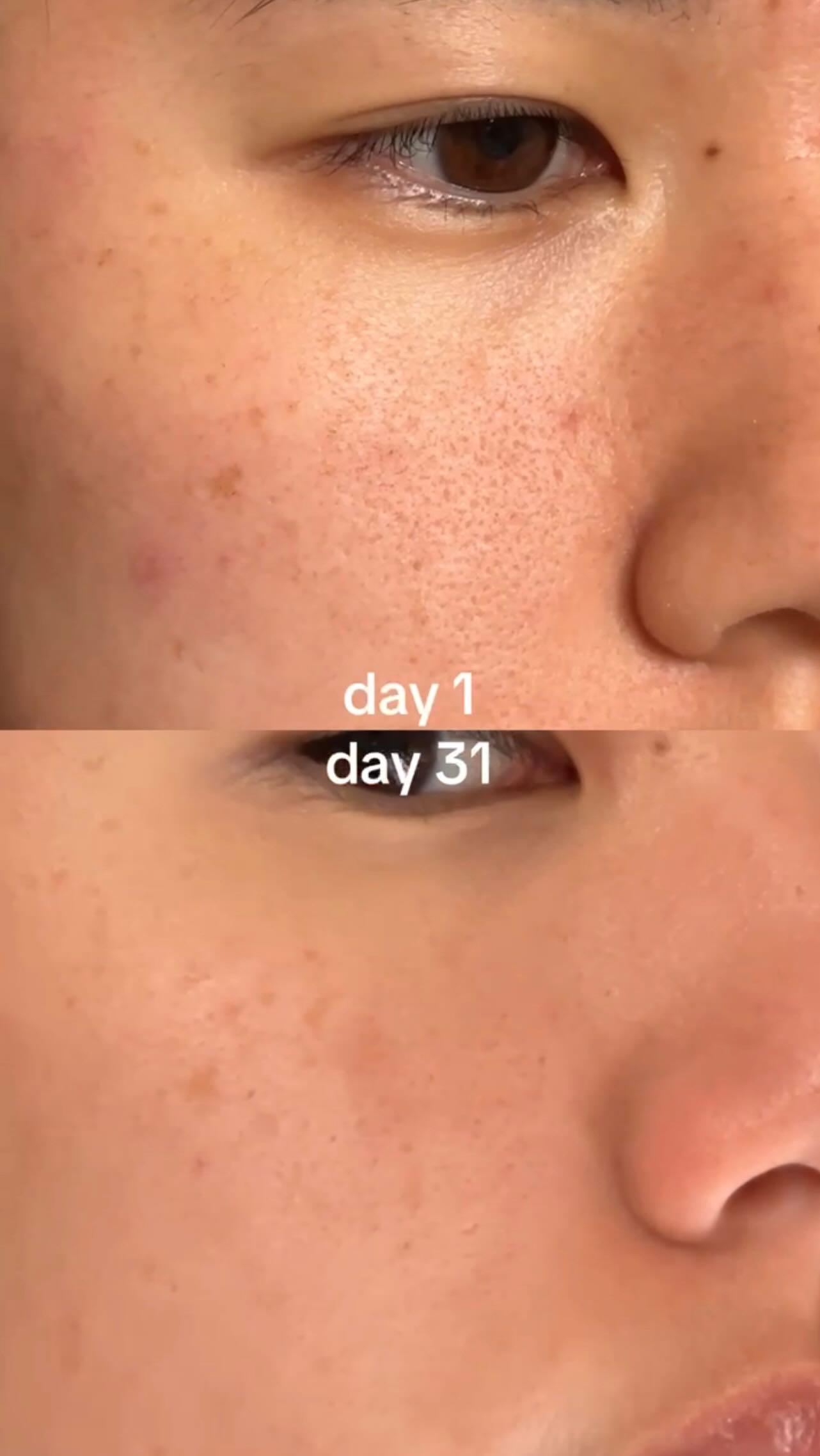 loving the visible results from ONE session of LaseMD Ultra @chenkaitlyn 🫶🏻 LOOK at the improvement in pore size!
Book our LaseMD Ultra laser facial treatment at lingspa.com available only at Union Square location #lingspa #laserfacial #laser #lasemdultra #skincare #nyc
