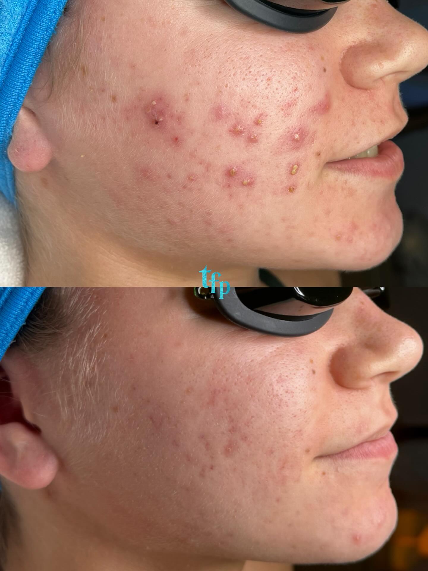 Clearing your acne naturally is possible with my biweekly Acne Bootcamp program. You can get clear skin in 3-5 months 🩵
How it works:
🪼Come in biweekly for acne facials (discounted to $99)
🪼Purchase a full customized skincare routine with me and do it morning and night at home (around $300 give or take)
🪼Switch to acne-safe makeup and laundry detergent
🪼Minimize acne triggering foods in your diet
Let’s get you clear once and for all! Book on thefaceplacemi.com ! I can’t wait to help you🌊🫶🏼