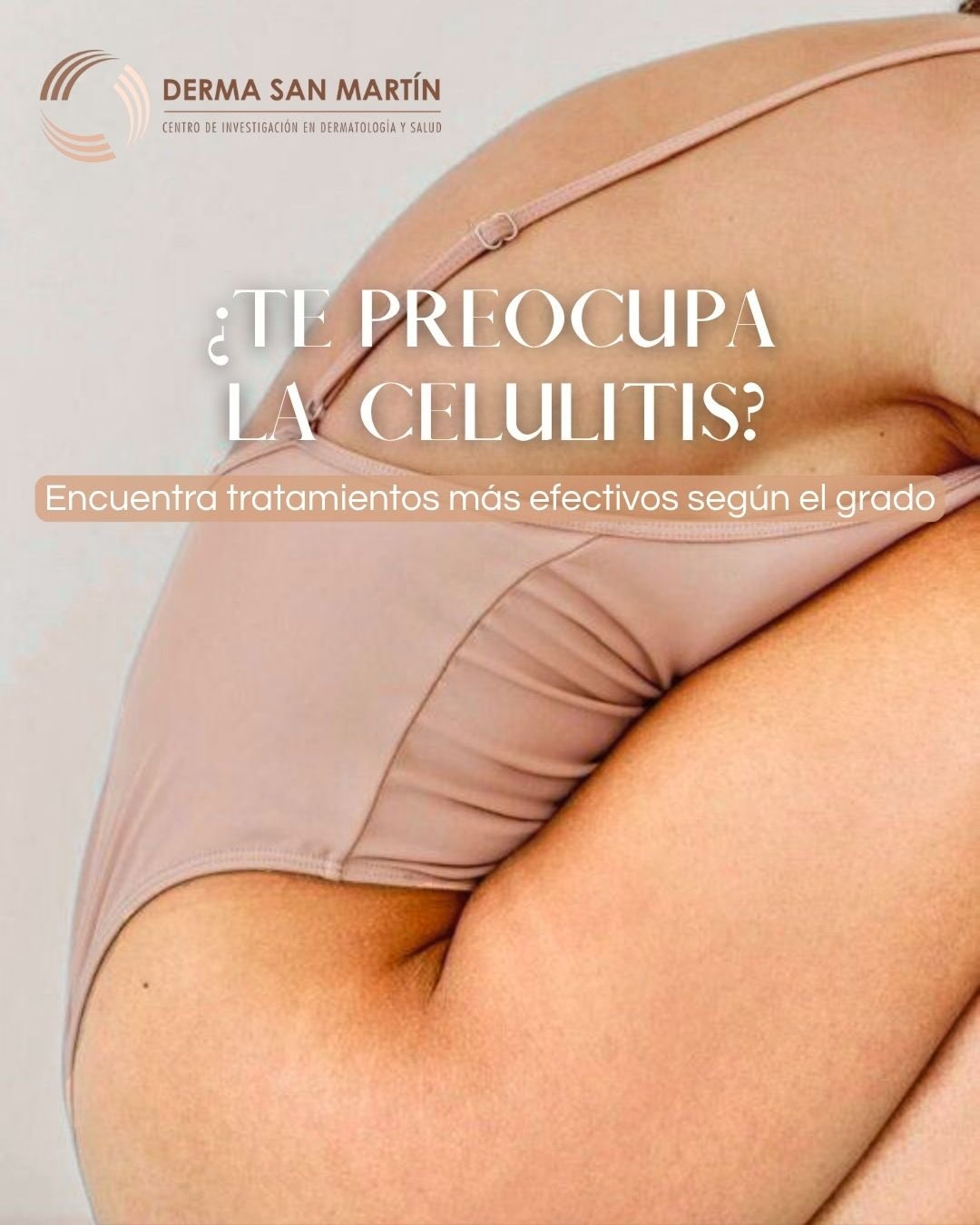 En Derma San Martin trabajamos con tratamientos especializados que actúan desde la raíz: mejoran la circulación, eliminan toxinas y reducen visiblemente el aspecto de piel de naranja.
?El resultado: una piel más suave, uniforme y lista para que disfrutes del verano con confianza.
✨ La celulitis no define tu belleza... pero sí podemos ayudarte a mejorarla
#célulitis #tratamientosestéticos #dermatologia