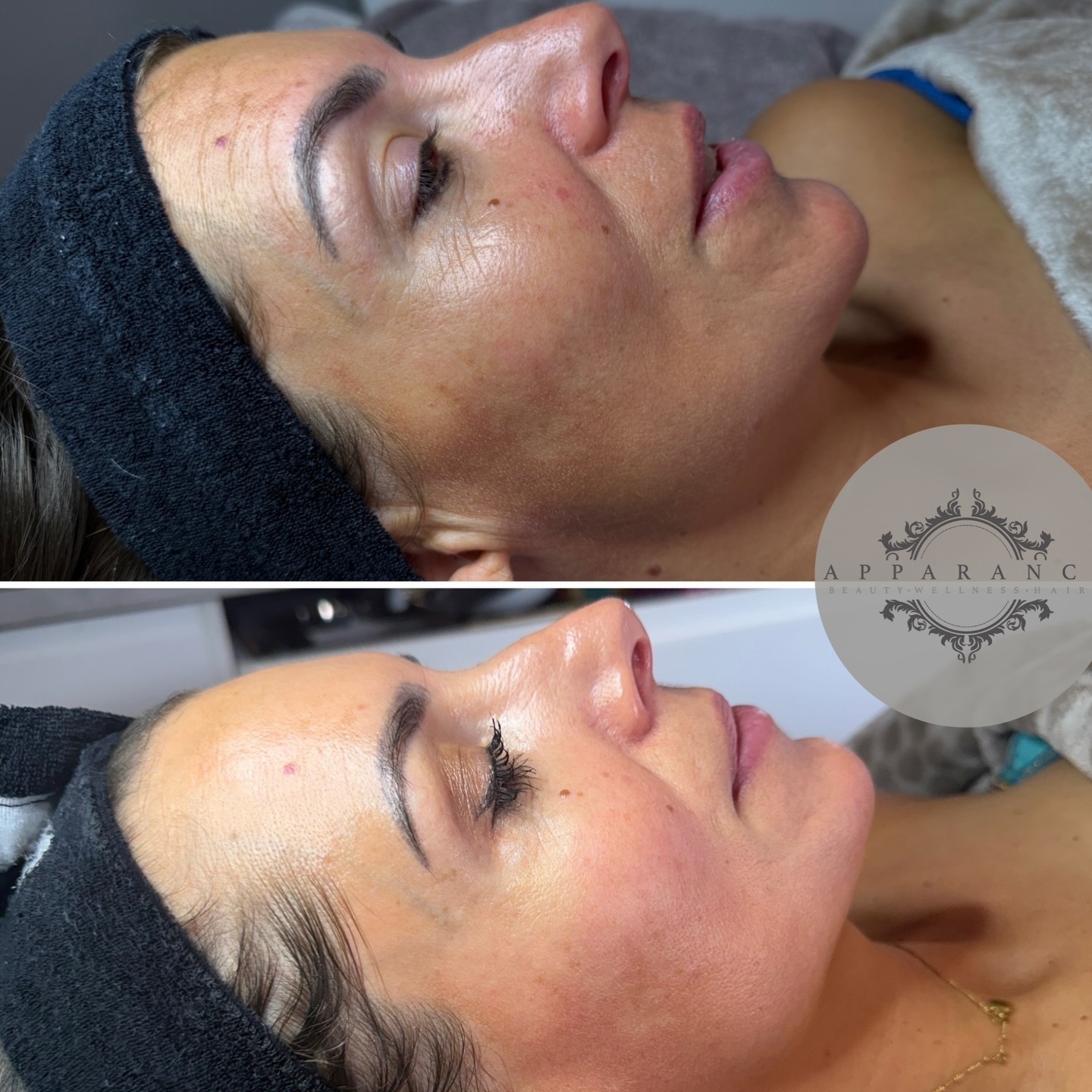 Wauw! Wat een resultaat weer ?✨
En dat na 1 behandeling met MELINE! ?
Kijk even hoeveel COLLAGEEN haar eigen huid heeft aangemaakt dankzij de boost aan RETINAL! De lijntjes bij de ogen en het voorhoofd zijn nauwelijks nog zichtbaar! Hier worden wij HUIDSPECIALISTEN van APPARANCE natuurlijk heel blij van! ?
Wil jij weten wat we voor jouw huid kunnen betekenen? Plan dan nu een intake en wij doen een GRATIS SKIN-CHECK! ??
Liefs,
Team Apparance