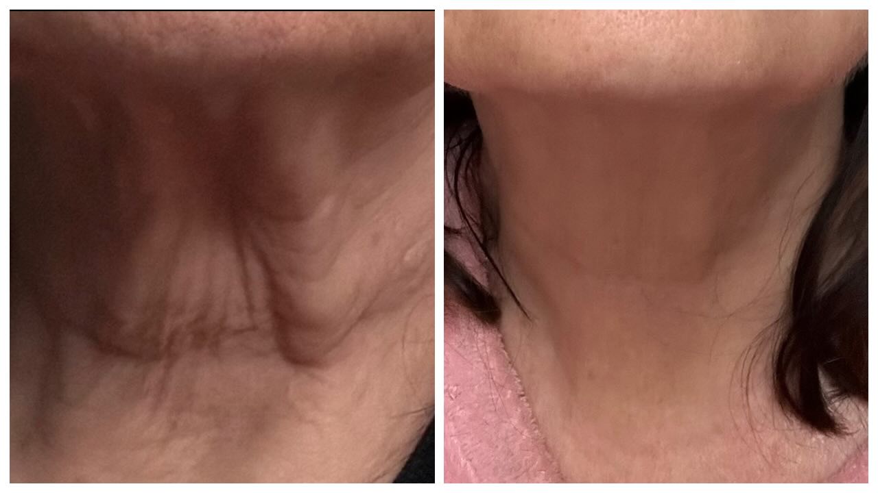Neck laxity is one of the TOP complaints I hear — and also one of the most misunderstood.
This patient’s neck transformation didn’t happen overnight.
In fact, these photos are nearly a year apart — and that’s exactly the point.
✨ What you’re seeing is consistent, strategic treatment over time, not a quick fix.
What we’ve done:
• Numerous microneedling sessions (almost monthly) to build collagen
• Filler placed in necklace lines to soften etched creases
• Multiple toxin treatments to reduce muscle pull and dynamic lines
And most importantly… patience.
The neck has thinner skin, fewer oil glands, and slower collagen turnover than the face — which is why it demands a long-game approach.
💡 Depending on the patient, we may also incorporate:
• Medical-grade skincare to improve skin quality
• Radiesse for collagen stimulation and structural support
• Red Light Therapy
• PRX
• Lasers
There is no single treatment that “fixes” neck aging — real results come from layering modalities, spacing treatments correctly, and allowing your body time to respond.
If you want honest outcomes, natural improvement, and a plan tailored to your anatomy — this is how we do it.
📅 Book a consultation and let’s talk about what your neck actually needs (and what it doesn’t).
—
Results take time. But when done right, they’re worth it.