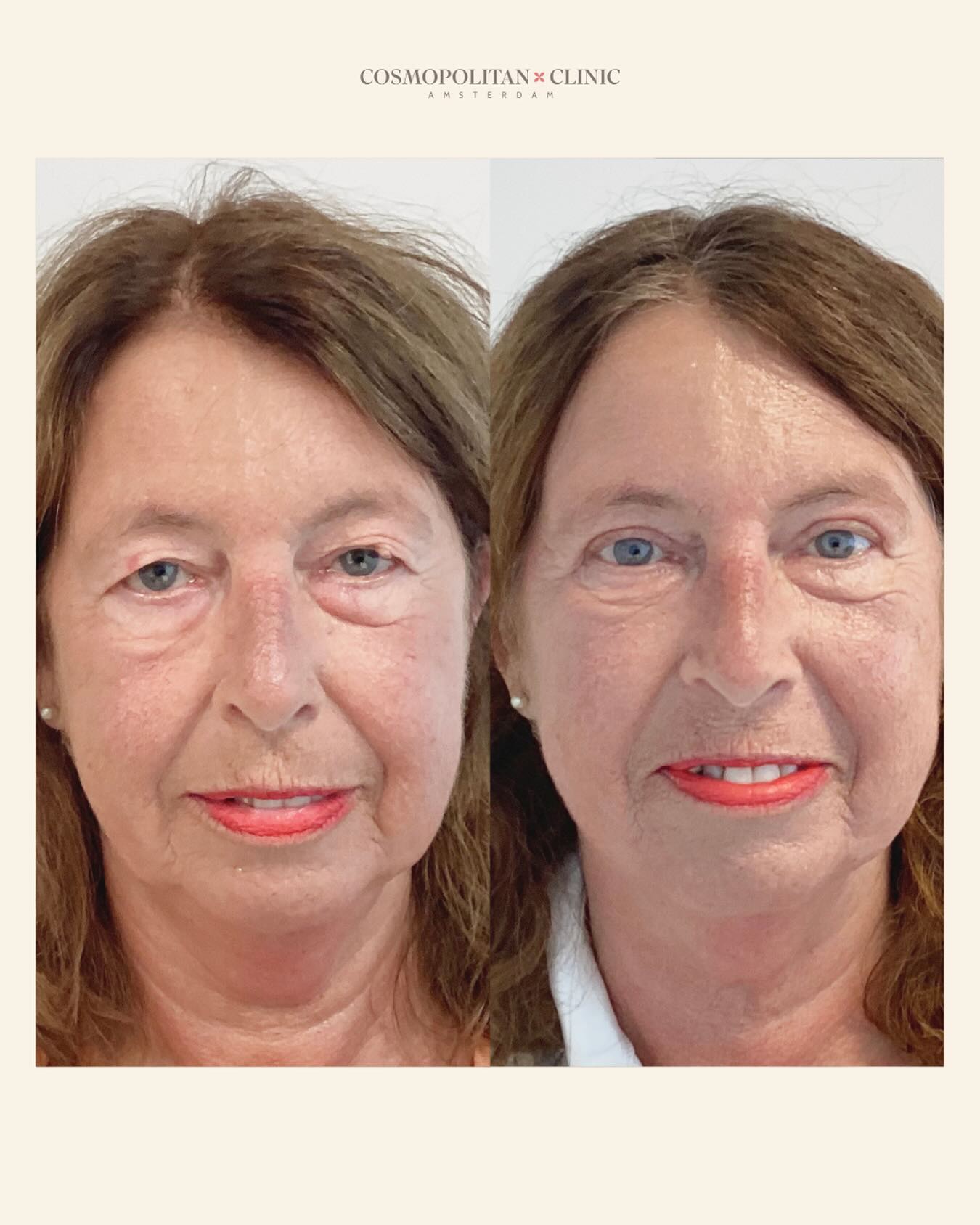 Before and after eyelid surgery ✨?
#eyelidsurgery #beforeafter #aestheticclinic