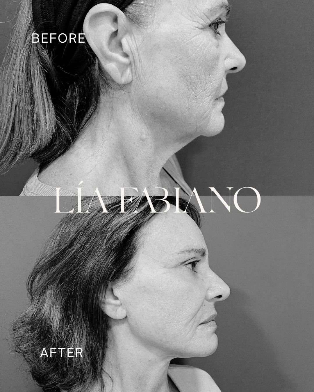 Subir un antes y un después no es solo mostrar un cambio, es contar una historia: la de la confianza, la decisión y el deseo de sentirse más alineada con una misma.
En nuestra paciente priorizamos sus necesidades y su belleza natural, realizando un lifting facial completo con reposicionamiento de amas, brow lift y blefaroplastia del tercio superior.
El objetivo no fue transformar su rostro, sino realzar su autenticidad.
? DM para más info
? +34 656334699
?Mallorca - Madrid - Barcelona
#LiftingFacial #BrowLift #Blefaroplastia #ResultadosNaturales #BellezaReal
-
Posting a before-and-after is not just showing a change, but telling a story of trust, decisions, and the desire to feel aligned with oneself.
For our patient, we prioritized her needs and natural beauty with a full facial lifting using amas repositioning, combined with a brow lift and upper-third blepharoplasty.
The goal was not to change her face, but to highlight her authenticity.
Today she reflects naturalness, freshness, and quiet strength.
#Facelift #BrowLift #Blepharoplasty #NaturalResults #RealBeauty