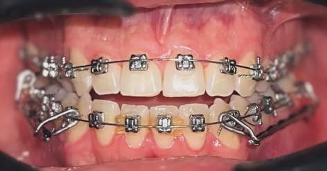 Tratamientos ortodóncicos con enfoque clínico avanzado. Exactitud clínica aplicada a cada movimiento. Planeación biomecánica de alto nivel.