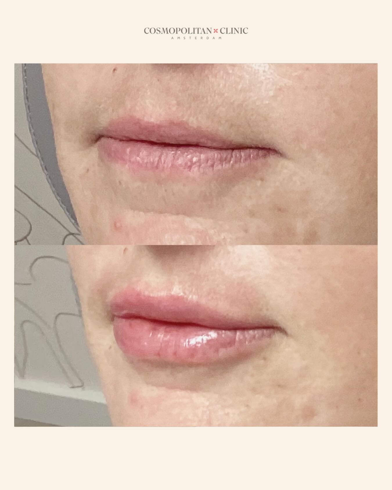 Mistletoe season is coming ?
Naturally enhanced lips, soft and subtle.
What do you think of the result?