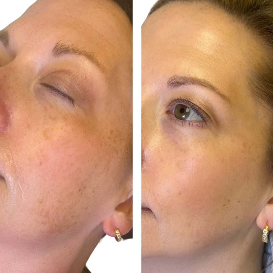 PRX Plus — Before & After (One Series)
This is the result after ONE series of PRX Plus ✨
No downtime. No major peeling. No filters.
One of the top concerns I see in practice is hyperpigmentation — dark spots, uneven tone, melasma, and post-acne marks. And it’s rarely caused by just one issue. Pigment is usually the result of inflammation, sun exposure, hormones, and barrier disruption, which means it needs to be treated thoughtfully.
PRX Plus works below the surface of the skin, stimulating collagen and cellular renewal without damaging the outer layer. That’s why it’s such a great option for pigmentation-prone skin — it improves tone and texture without triggering the irritation that can sometimes make discoloration worse.
What PRX Plus is doing at a deeper level:
• improves overall skin quality and density
• supports controlled cellular turnover
• brightens and evens tone
• softens fine lines and textural irregularities
• strengthens the skin so it behaves better long-term
Because PRX Plus isn’t aggressive, it’s ideal for patients who want visible improvement without downtime. It is also noninvasive, so it’s a great first step for aesthetic naive patients.
That said, hyperpigmentation is rarely a one-treatment solution.
Depending on your skin and goals, treatment plans may also include:
• Microneedling to remodel collagen and improve stubborn pigment
• Chemical peels to address surface discoloration and dullness
• Medical-grade skincare, including pigment-correcting products like
– ZO Brightalive
– ZO Pigment Control + Blending Crème
– Daily Power Defense
– Broad-spectrum SPF (non-negotiable)
• Lasers
Sometimes PRX Plus is the main treatment (complete a series once every 9-12 months, individual treatments can be done thereafter monthly/bimonthly).
Sometimes it’s layered with microneedling, peels, or targeted skincare for better, longer-lasting results.
My role isn’t to push a single service — it’s to create a strategic, customized plan that treats pigment safely and effectively.
This is skin quality work.
And this is how we get results that actually last 🤍
Book PRX Plus under Skin Treatments or message us to build a personalized plan.