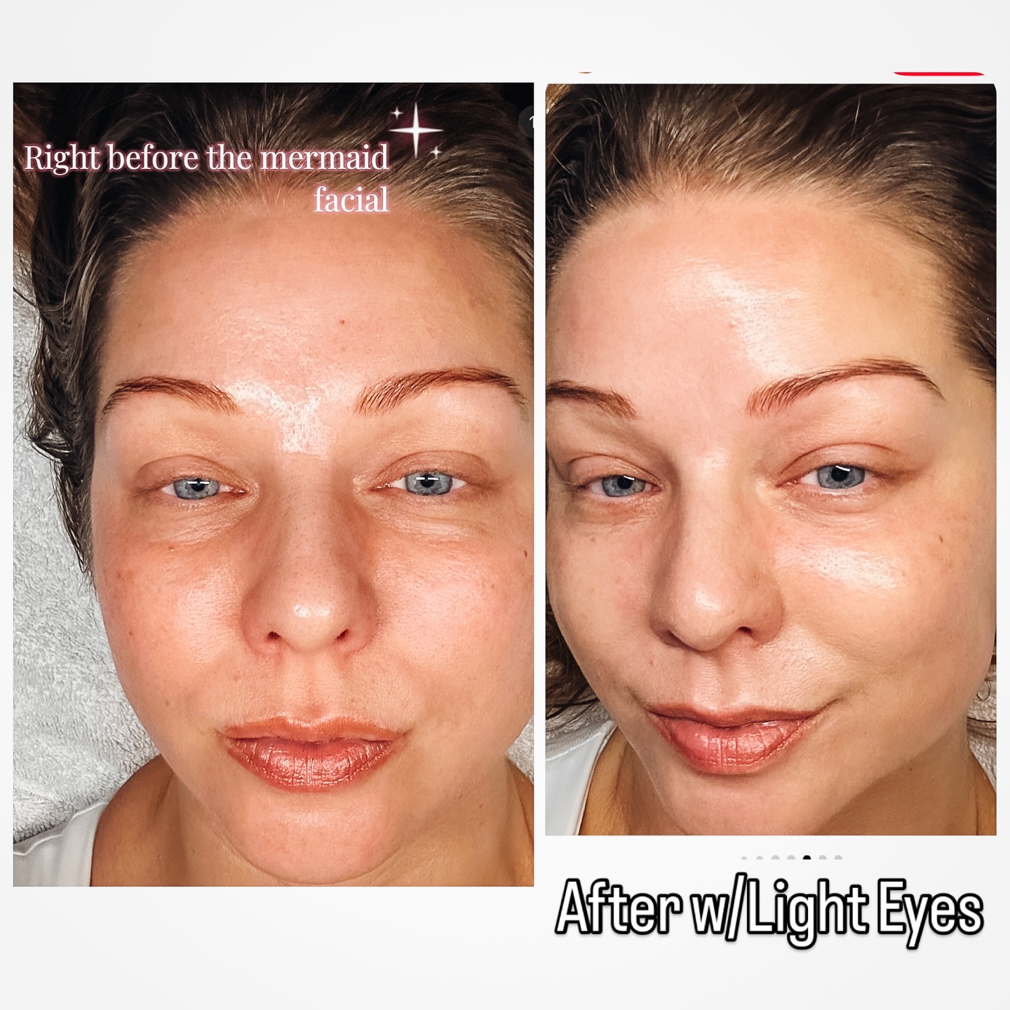 This is my clients selfies before and after her Mermaid Facial with Light Eyes! Yes, you read that correctly! Even if you have hereditary, under eye, darkness and puffiness….Light Eyes Ultra is the latest and greatest non invasive brighting & tightening, no injection treatment.
👉🏼What is it?
A combination of 5 bestselling biostimulant & mesotheraputic serums 🤌🏻🤌🏻🤌🏻 the perfect formula for the ultimate topical collagen forming & antioxidant treatment for the entire face, which also includes eyes!
Who benefits from the Mermaid Facelift or Light Eyes Ultra?
Anyone can do the Mermaid Facial🧜♀️, it’s safe and effective for all ages, skin types AND SUN SAFE! ☀️
👉🏼What’s in it?
@promoitalia.usa has the most innovative serums made in Italy 🇮🇹 and this treatment combines HA, PDRN (hydration, cellular signaling & repair, melanin protector), PLLA (volume & skin thickening), light eyes (for eye circles and eye bags), fixer (for wrinkles and fine lines) and Bacio (the first & only lip biostimulator that builds volume without filler).
The Mermaid 🧜♀️ treatment doesn’t just make you look amazing it actually turns back the hands of time by repairing tired, aging cells back to their luster and creates fibroblast & collagen fibers at an accelerated rate!
While it might sound unusual at first, this powerful ingredient is transforming the world of skin rejuvenation. No, it doesn’t literally use salmon sperm. It’s a treatment that consists of a biocompatible protein derived from fish DNA, which is then applied to the skin, often in combination with microneedling to help facilitate absorption and improve healing time from treatment.
👉🏼Perfect for all skin types, this facial offers a personalized experience that leaves your skin radiant and refreshed.
Book a consultation at www.GlowSkinScience.com
(Link in Bio)
#salmonspermfacial #lighteyes #themermaidfacial #darkcircles #koreanskincare