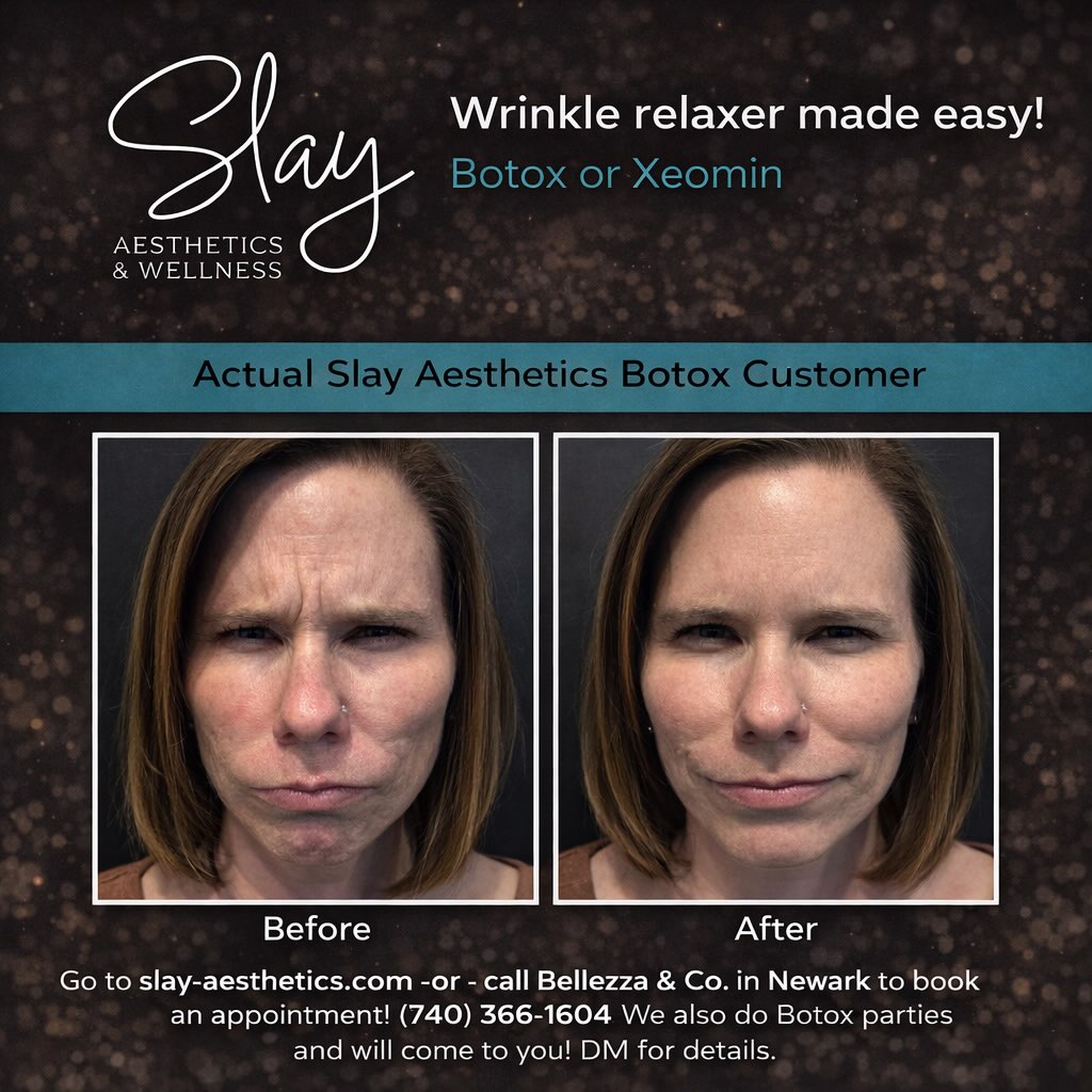 Before ➡️ After
Same face. Softer lines. Refreshed—not frozen.
Botox & Xeomin done with intention, balance, and natural results 🤍
If you want to look like you, just more relaxed—this is for you.
📍 Newark
📲 DM to book