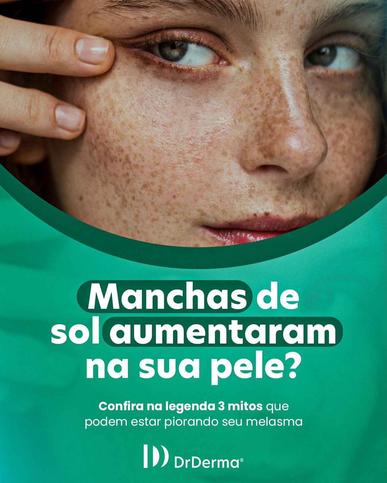 Talvez o problema não seja só o sol… mas alguns mitos que muita gente ainda acredita.
👇 ❌ Mito 1: “Só preciso usar protetor quando está sol” Nuvens, luz visível e até a luz do celular também estimulam o melasma. Protetor solar é todos os dias, faça sol ou não.
❌ Mito 2: “Protetor uma vez ao dia é suficiente” O efeito do protetor diminui com o tempo, suor e oleosidade. Sem reaplicação, a pele fica desprotegida e as manchas escurecem.
❌ Mito 3: “Produtos clareadores resolvem sozinhos” Sem proteção solar adequada e rotina correta, nenhum ativo clareador funciona como deveria , e o melasma tende a voltar.
Se você quer aprender a tratar sua pele do jeito certo, continue acompanhando nossos conteúdos.