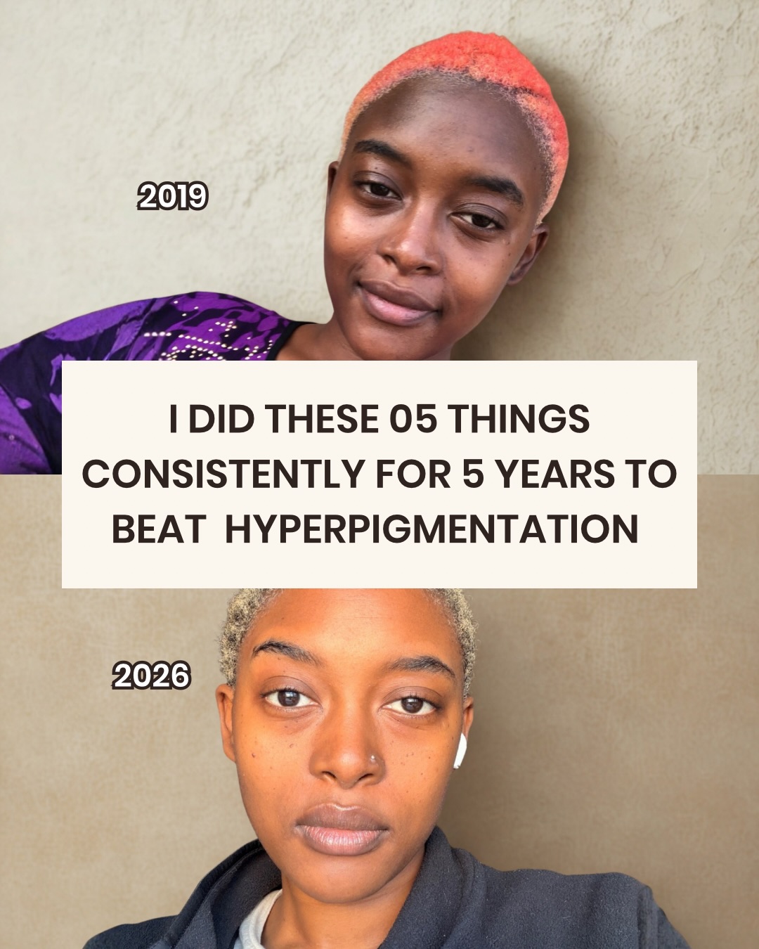 How many of these do you apply when treating your hyperpigmentation and how well has it worked for you?
#hyperpigmentationtreatment #ski̇ncareti̇ps