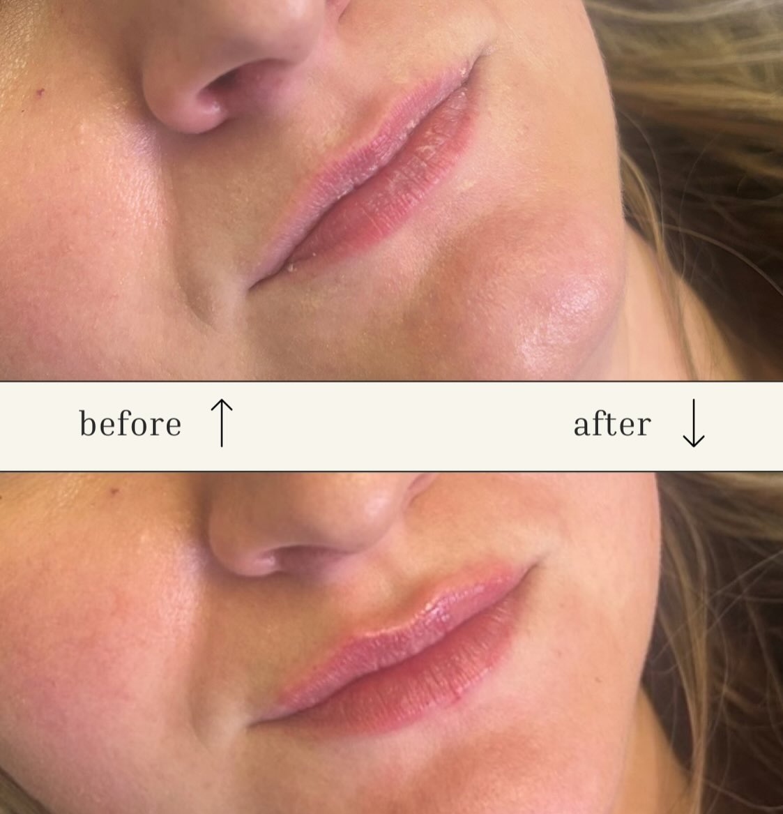 This is a full 1 syringe of lip filler—placed strategically to enhance her anatomy, not create someone else’s lips.
Her goal: more volume, but subtle
My goal: balance, shape, and proportion
That’s why you’ll notice:
• The syringe looks different in each lip
• Placement varies side to side
• Volume is distributed intentionally—not evenly
And a reminder I always love to share:
🫐A syringe is only about the size of a blueberry.
Small amount. Thoughtful technique. Big difference.
Natural results aren’t about using less filler—they’re about using it correctly.
Book when you’re ready for lips that still look like you.