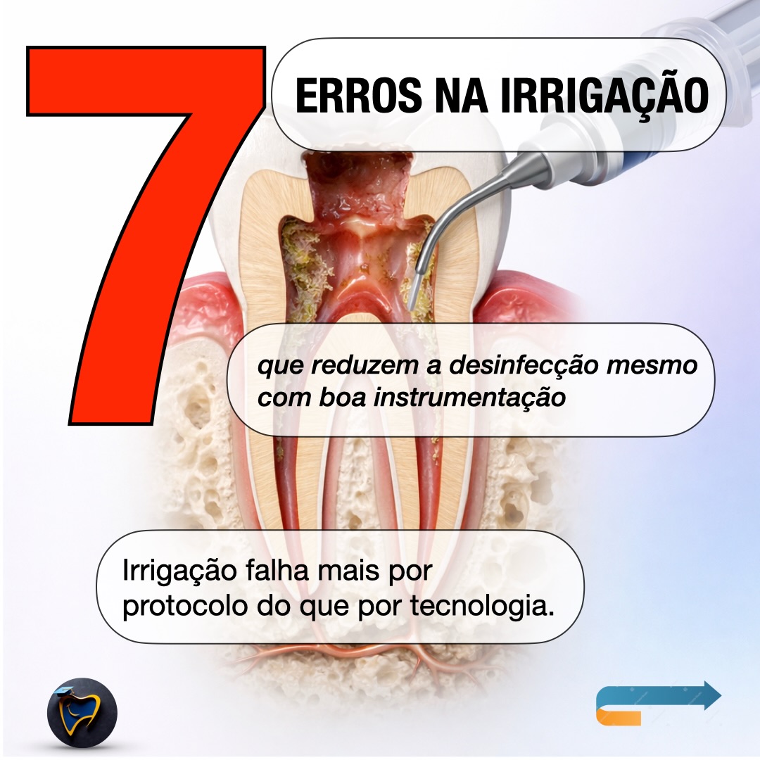 Na irrigação endodôntica, o que falha com mais frequência não é o irrigante — é o protocolo.
Mesmo com boa instrumentação, istmos, reentrâncias e áreas não tocadas dependem de renovação, penetração e ativação para reduzir carga microbiana.
✅ 7 erros que mais sabotam a desinfecção:
1. Volume sem renovação e controle hidrodinâmico
2. Irrigação passiva em anatomia complexa (sem ativação)
3. Ativação sem segurança apical (↑ risco, ganho desproporcional)
4. EDTA por tempo excessivo (erosão/fragilização)
5. NaOCl + CHX sem irrigação intermediária (precipitado)
6. Ignorar glide path + preparo cervical (estagnação/pressão apical)
7. Tratar irrigação como etapa isolada (perda de coerência biológica)
#endodontia #endodontiamicroscópica #endotoday #dentista #odontología