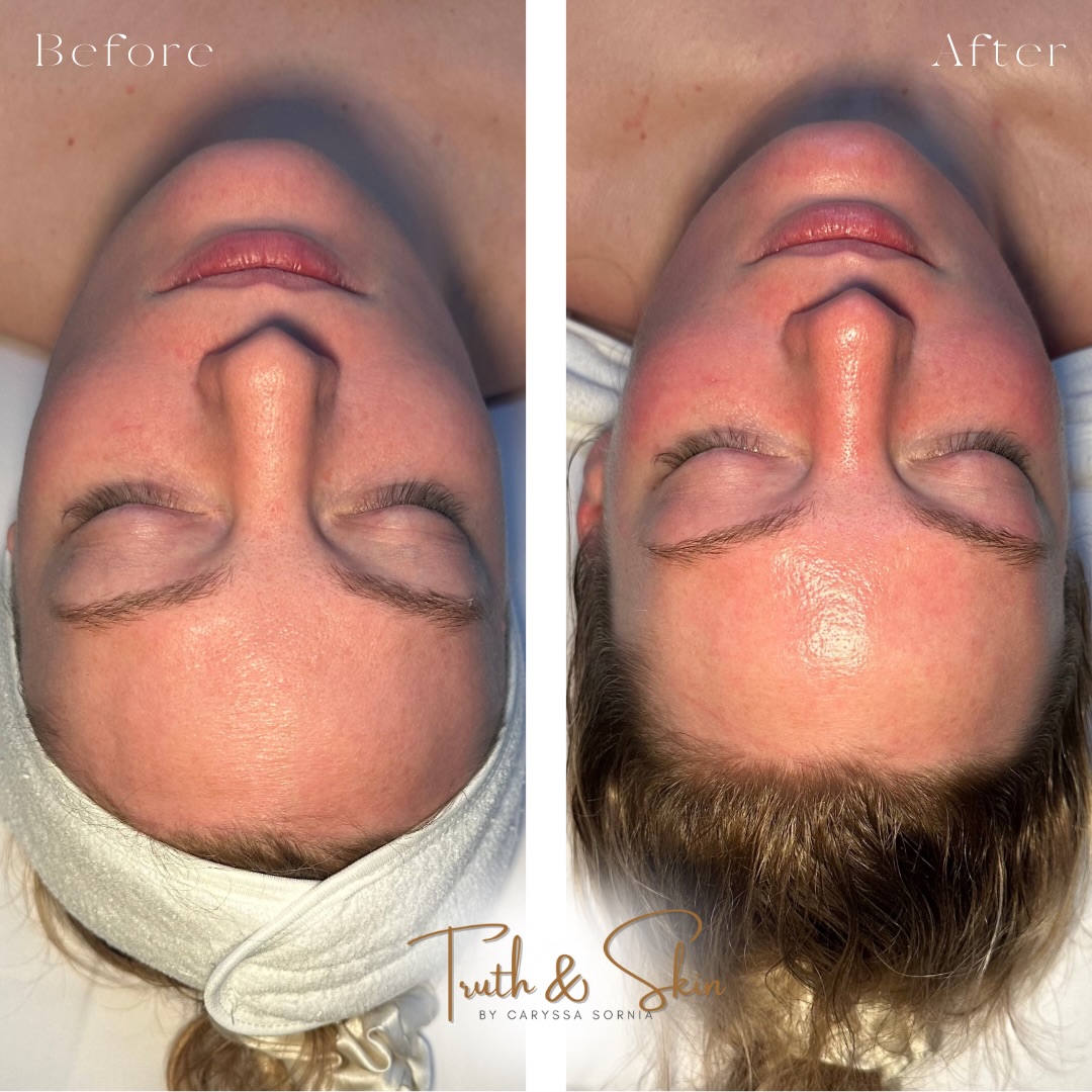 Sometimes all you need is a targeted 30-minute reset.
Other times, it’s 90 minutes of deep relaxation, realignment, and intentional care ✨
This before & after is proof of intentional care, customized techniques, and treatments that go deeper than the surface.
No two sessions are the same because your skin deserves personalized care every time.
Book your custom treatment through the link in my bio 🤍
📍1449 W 9 Mile Rd, Ste 1 | Pensacola, FL 32534
#customizedfacial #pensacola #koreanskincare